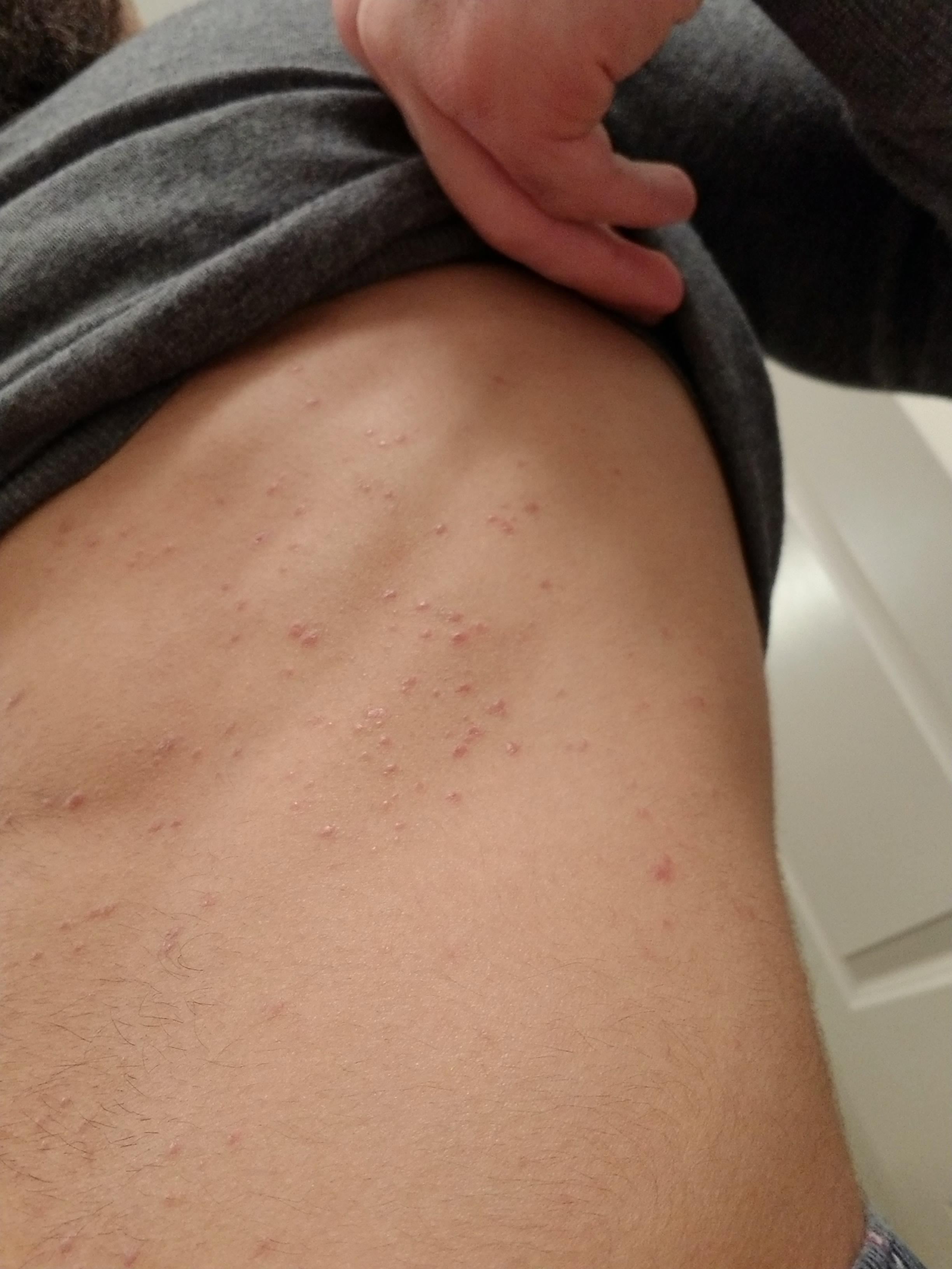 Bed Bug Bites? Thought it was razor burn, but now getting new bites on
