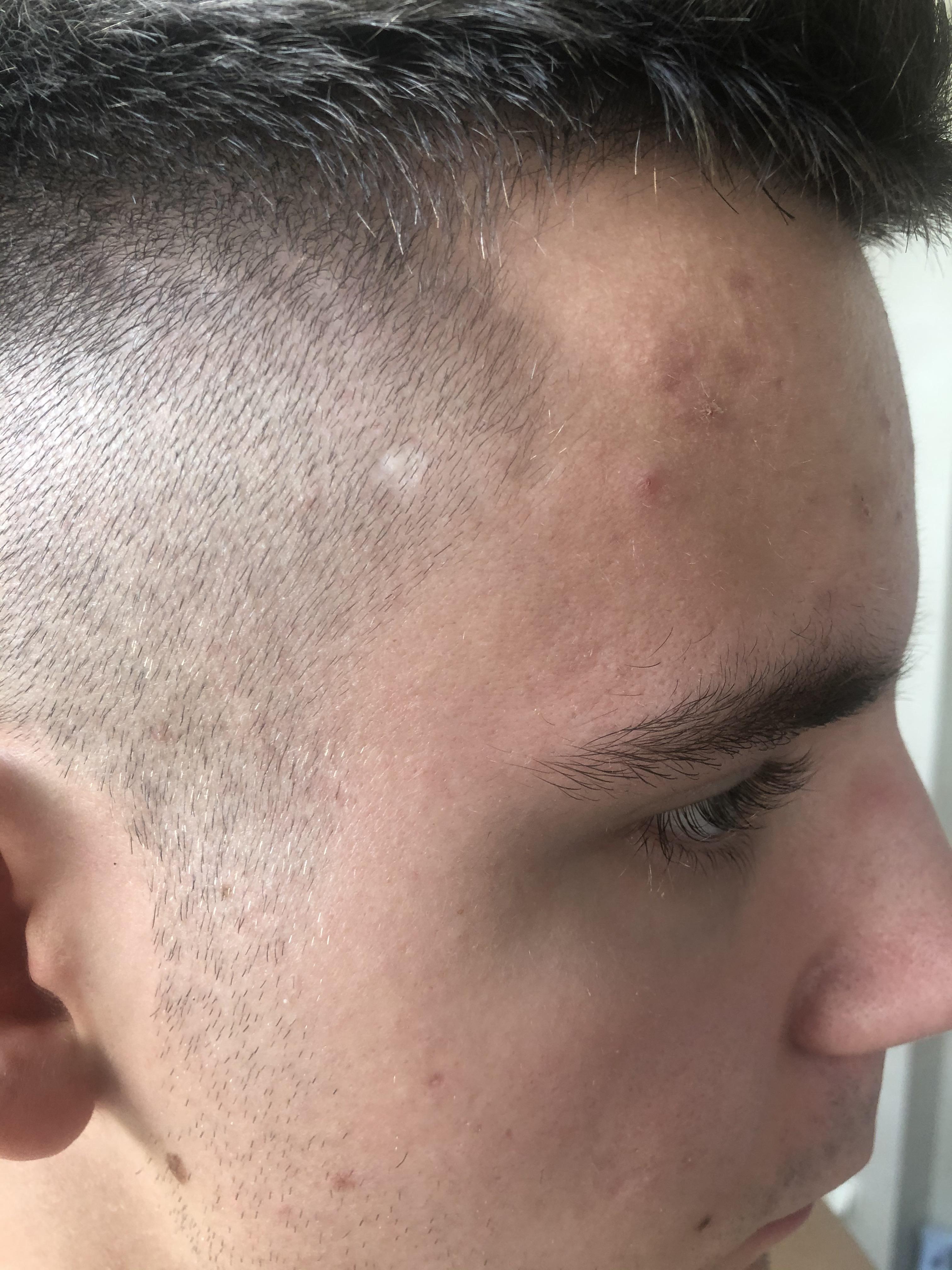 I noticed white “mole” on my scalp when I got short haircut. What it