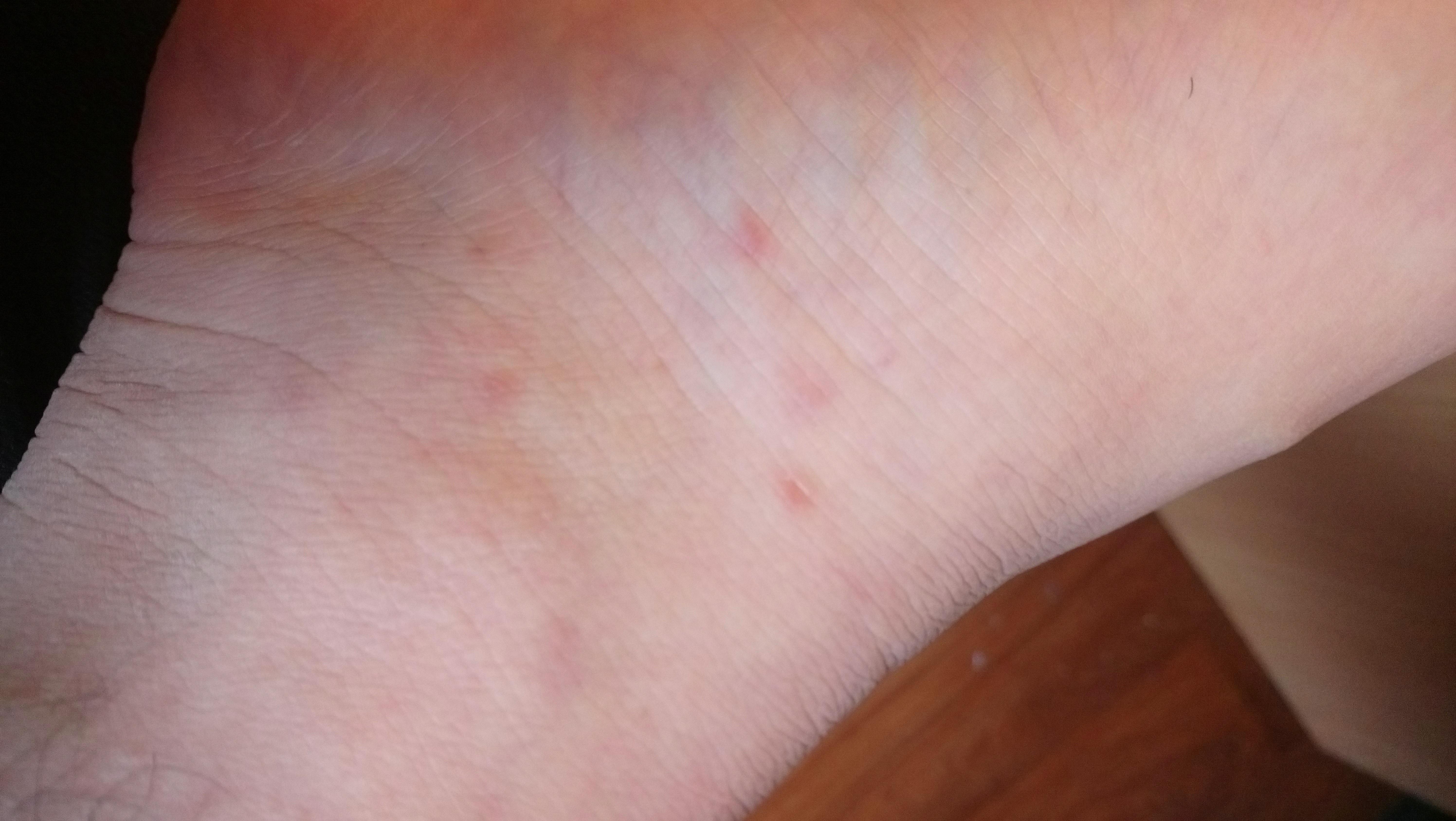 19M, Random red spots appearing on my foot these few days, slightky