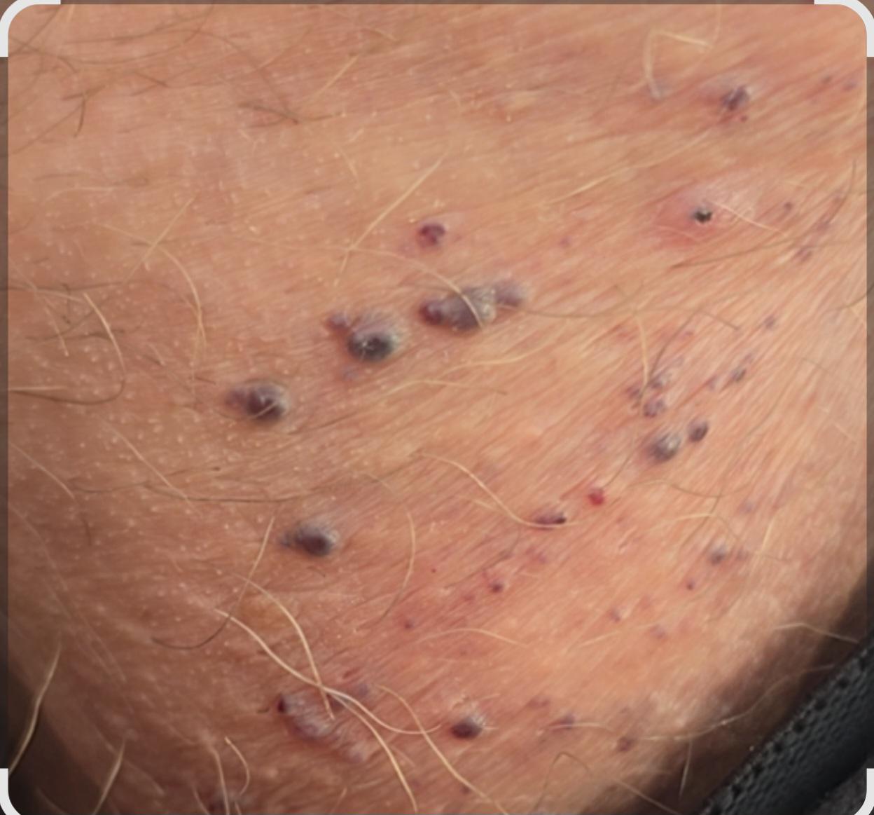 Pimples On Testicles Testicle Lump Causes Diagnosis Treatment And