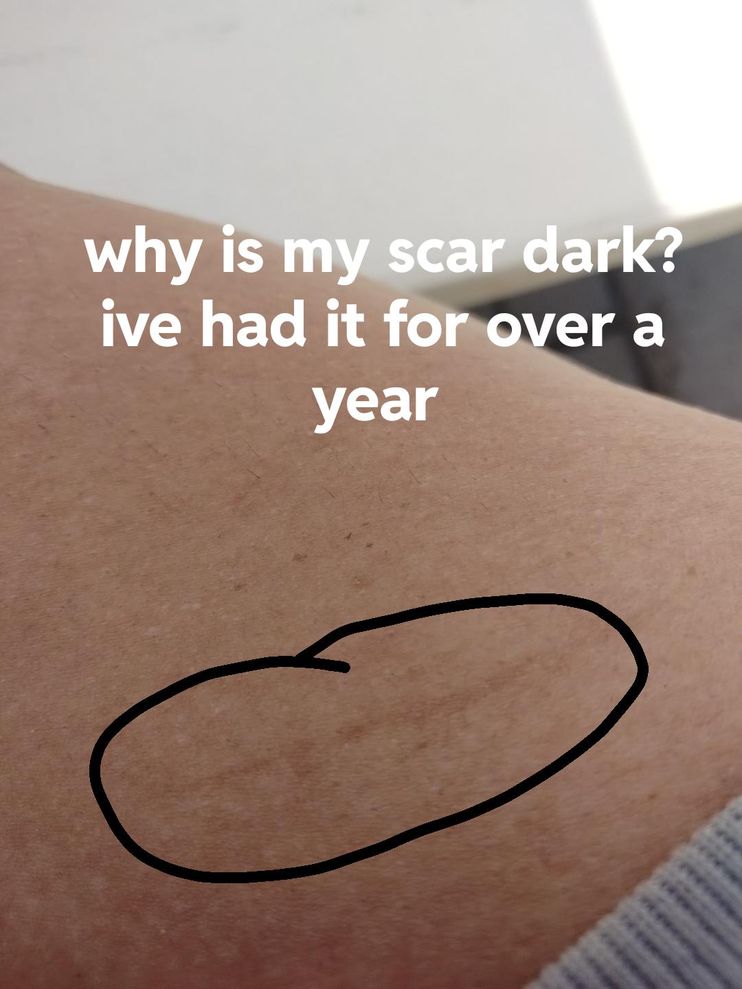 Scars? r/medical