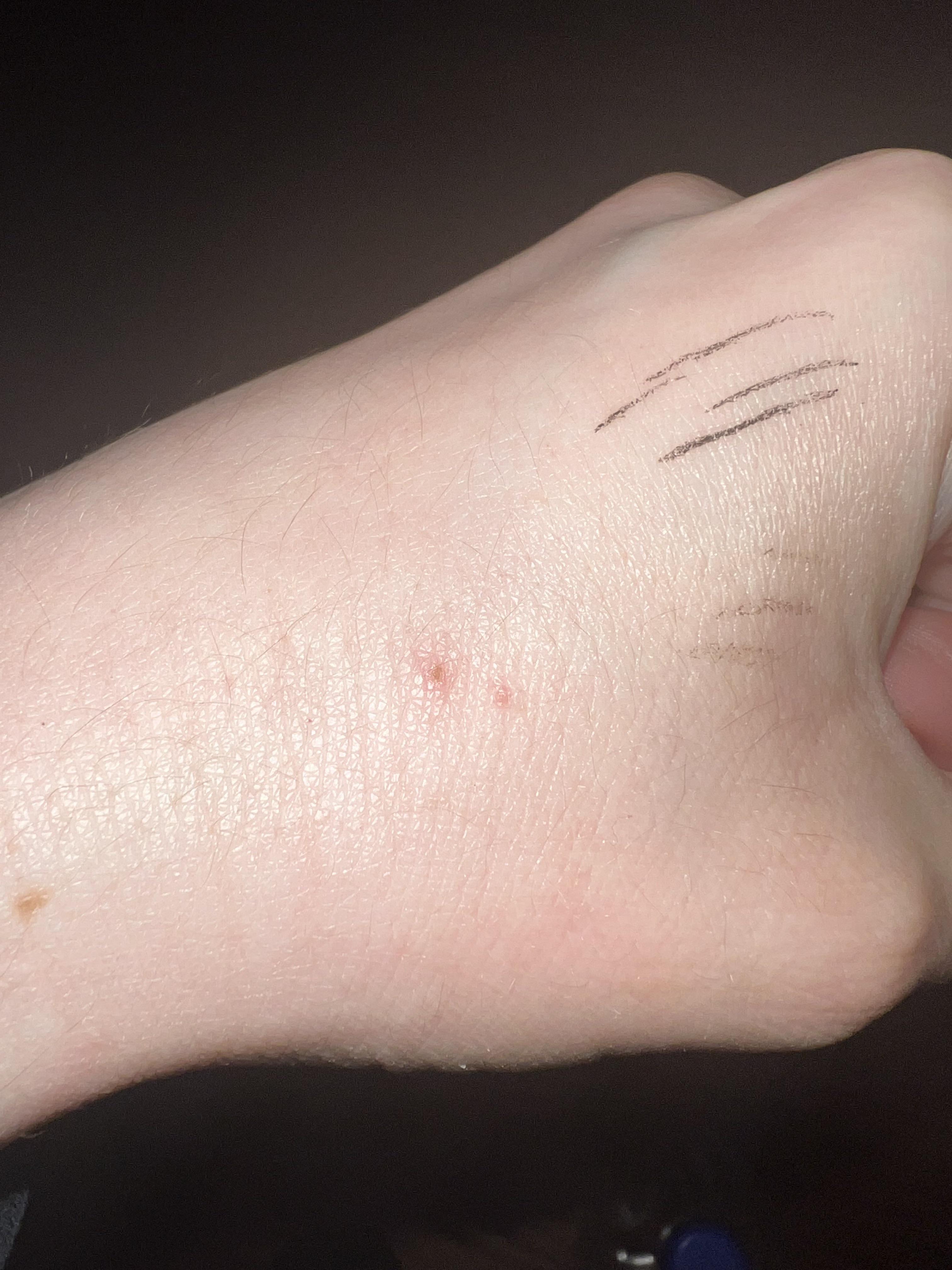 Hi, could this be a bat bite? I slept with the windows open a few days