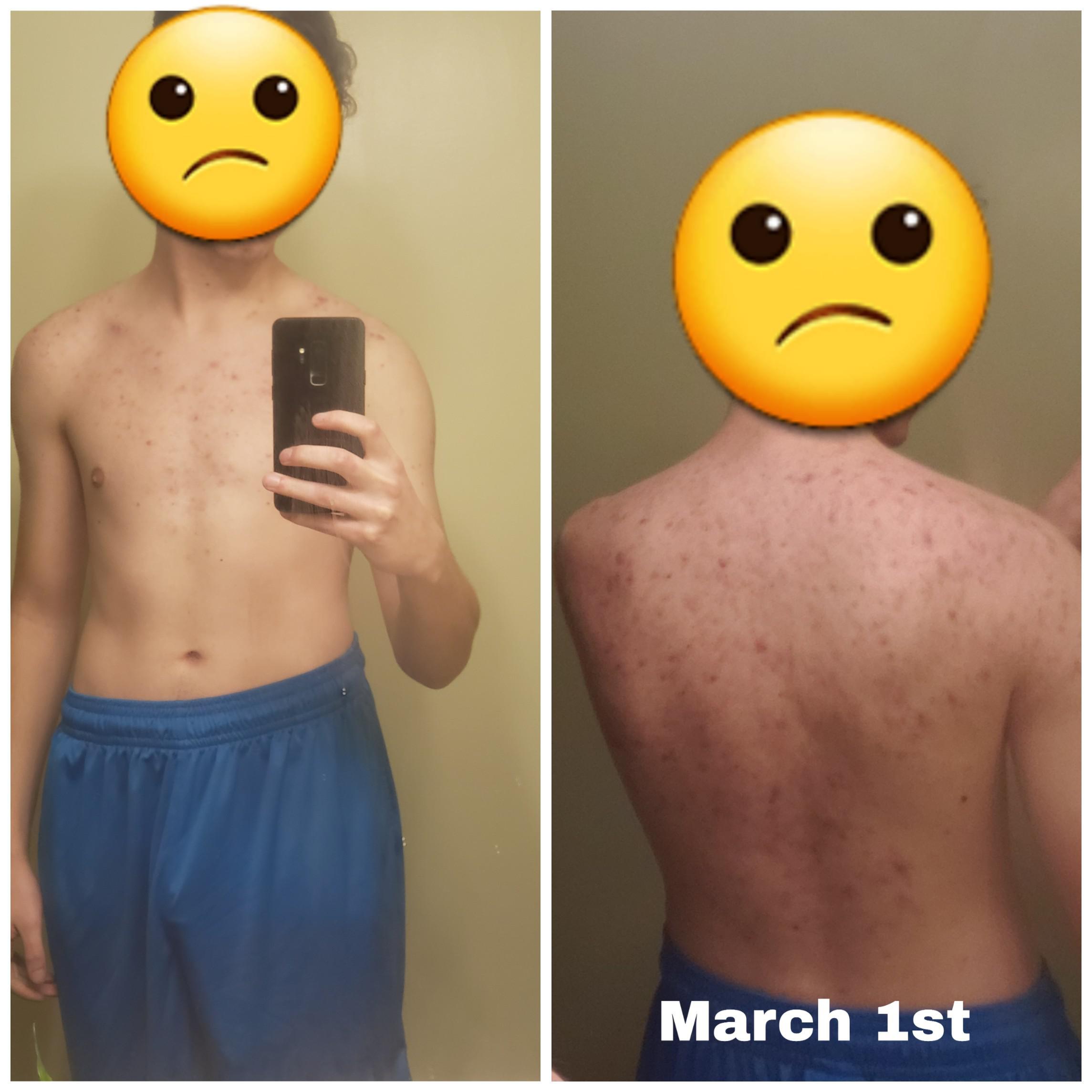 19 Have bad Bacne and Chest Acne. Currently taking Doxycycline