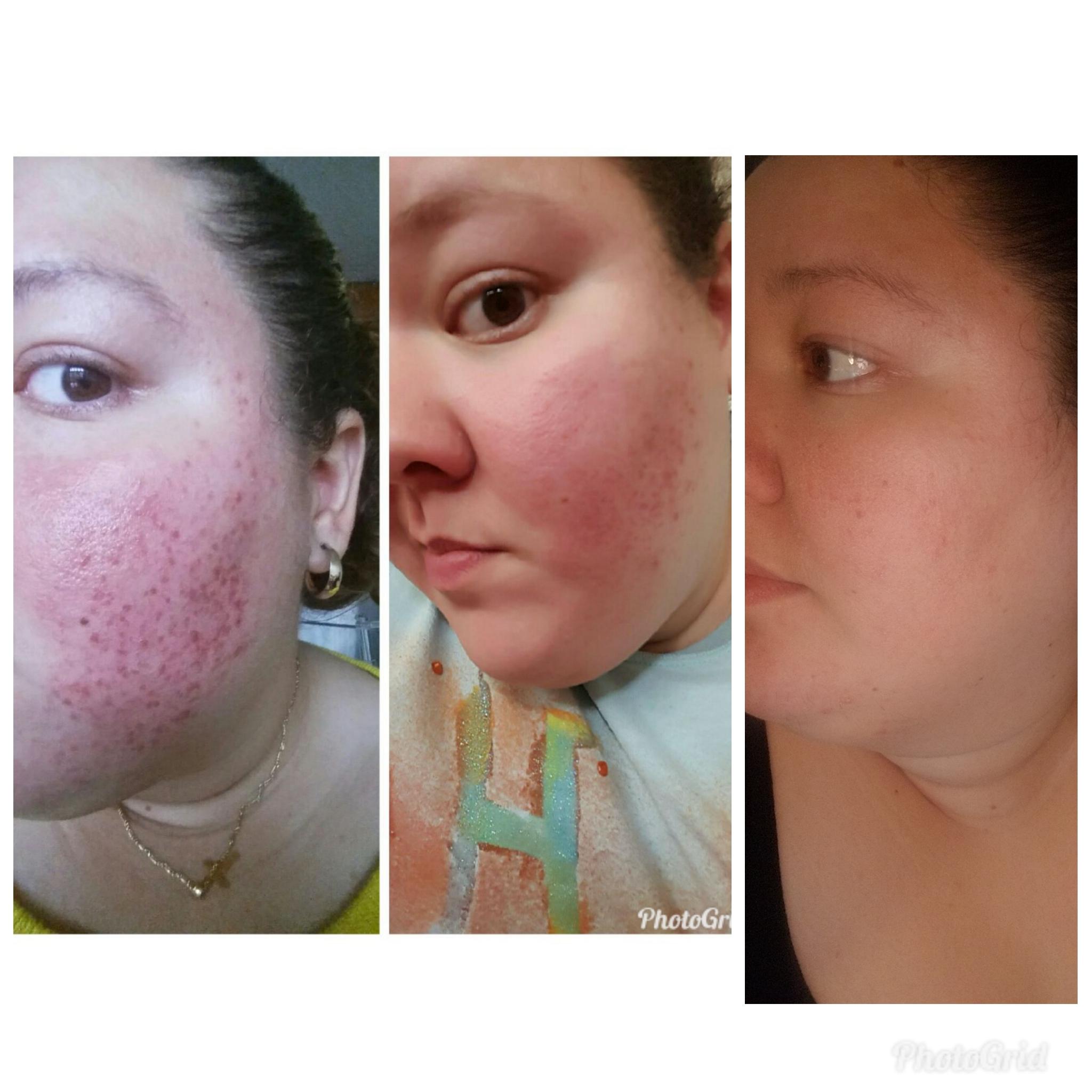 A year without drinking cows milk! r/acne