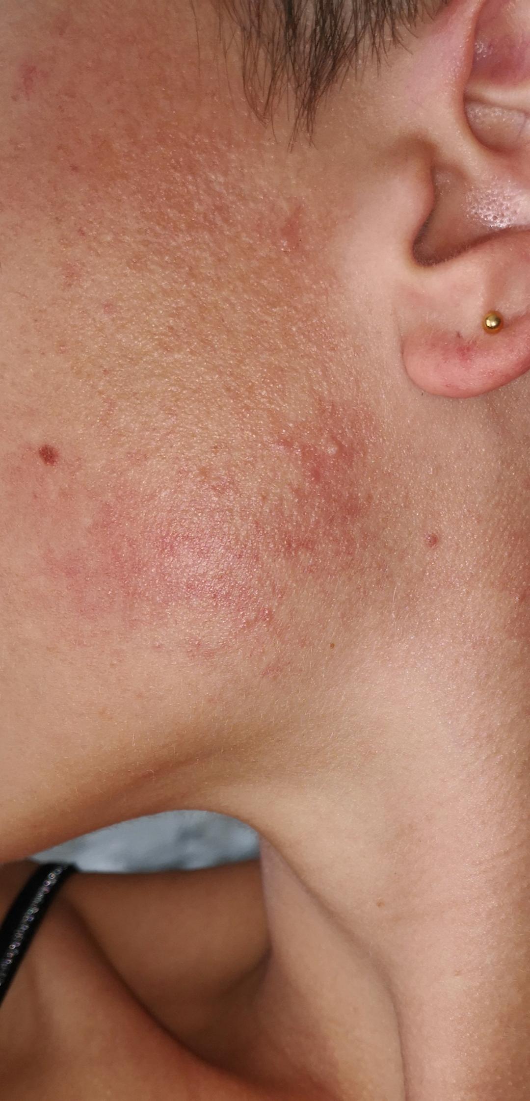 [skin concerns] I just found out in an other sub, after being diagnosed