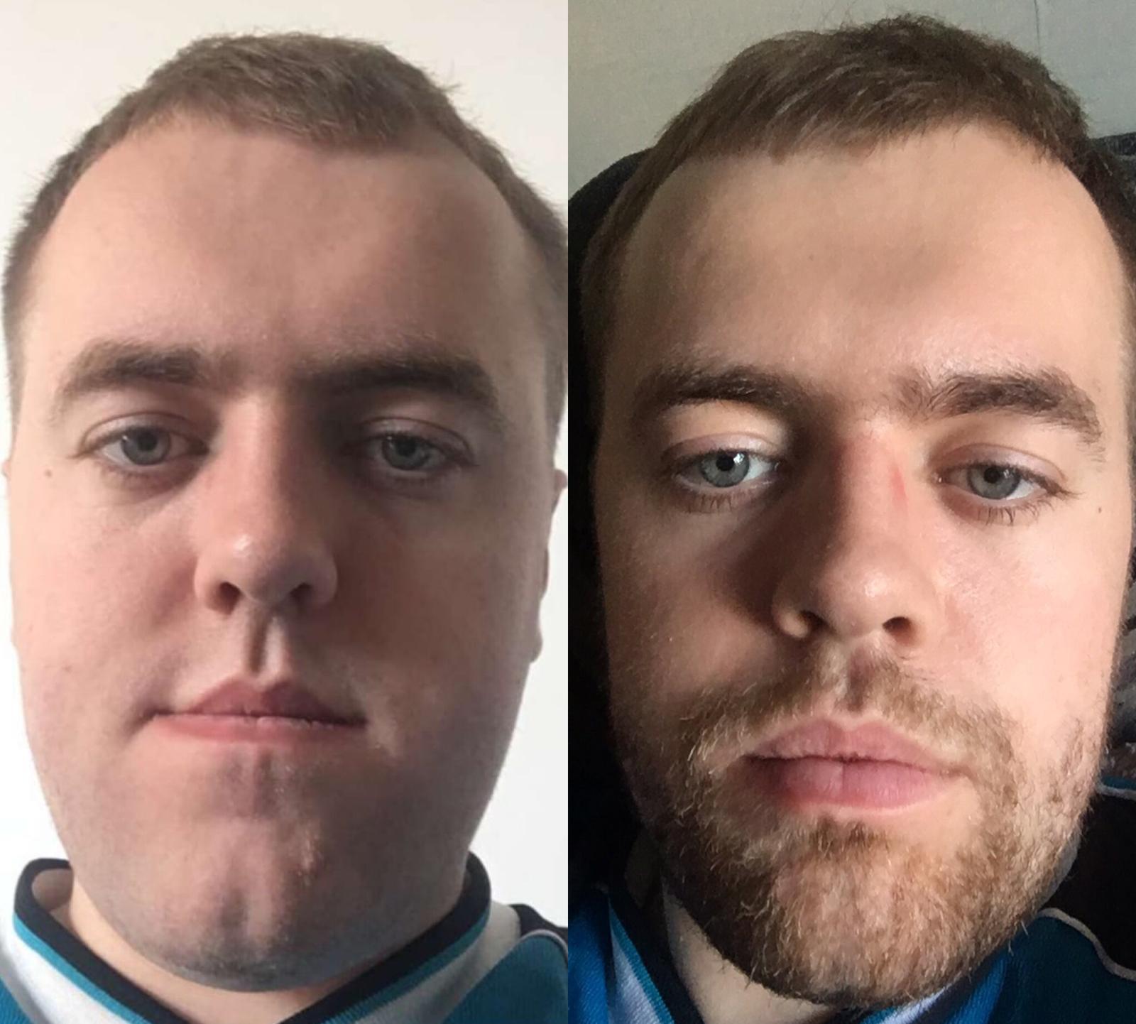 2 Weeks post double jaw surgery! Really happy with the progress. r