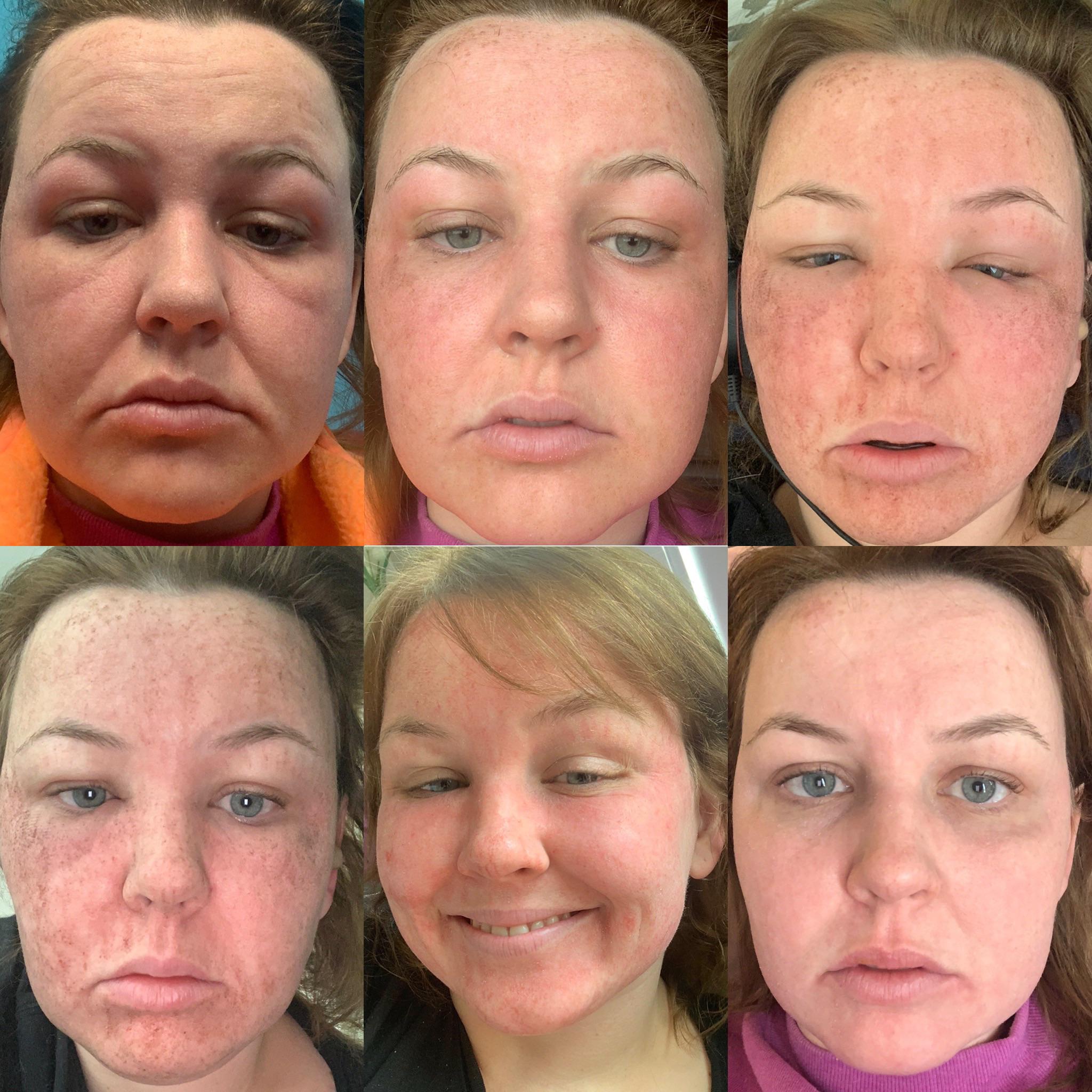 Collection 100+ Images Carbon Laser Facial Before And After Photos Superb