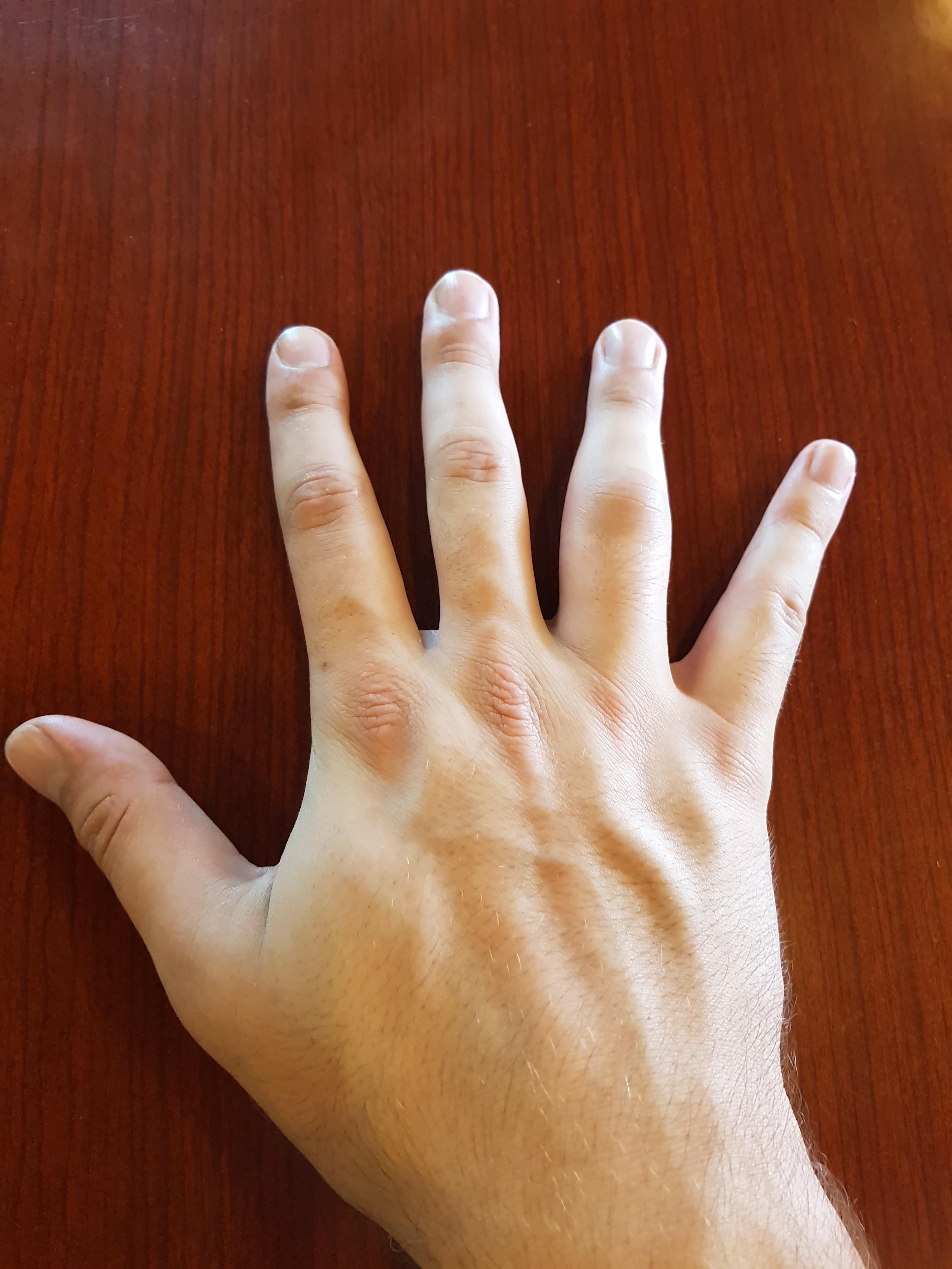 A ball hit my ring finger, it was swollen and purple, after a day or