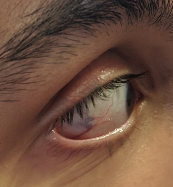 Brother notices weird blue and red squiggles on my eye should I see