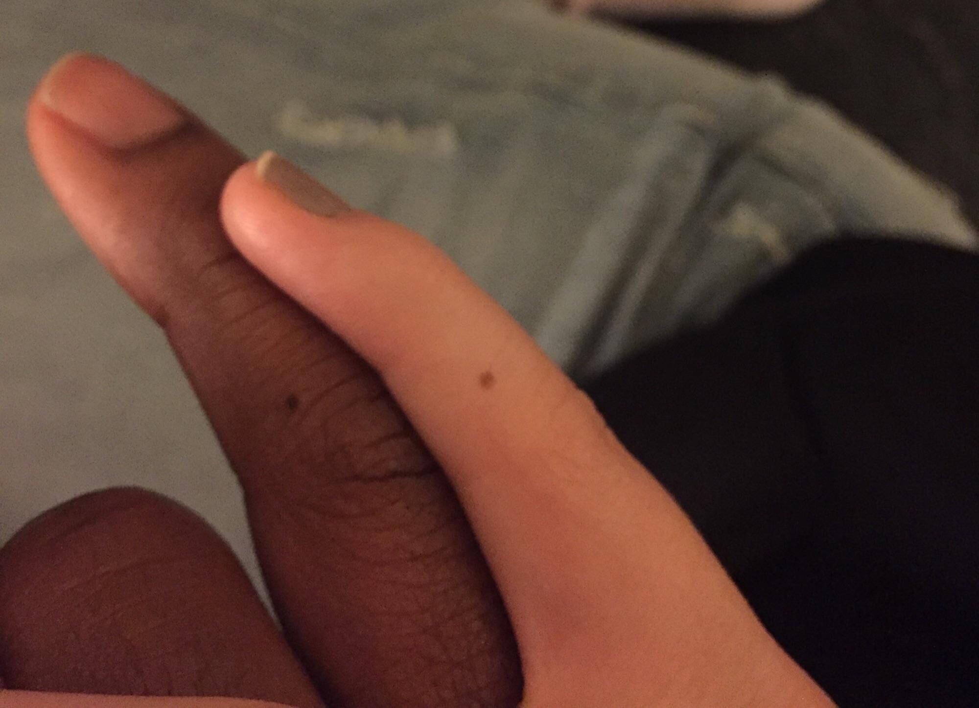 Boyfriend And Girlfriend Have Same Birthmark On The Same Finger. : R/Nevertellmetheodds