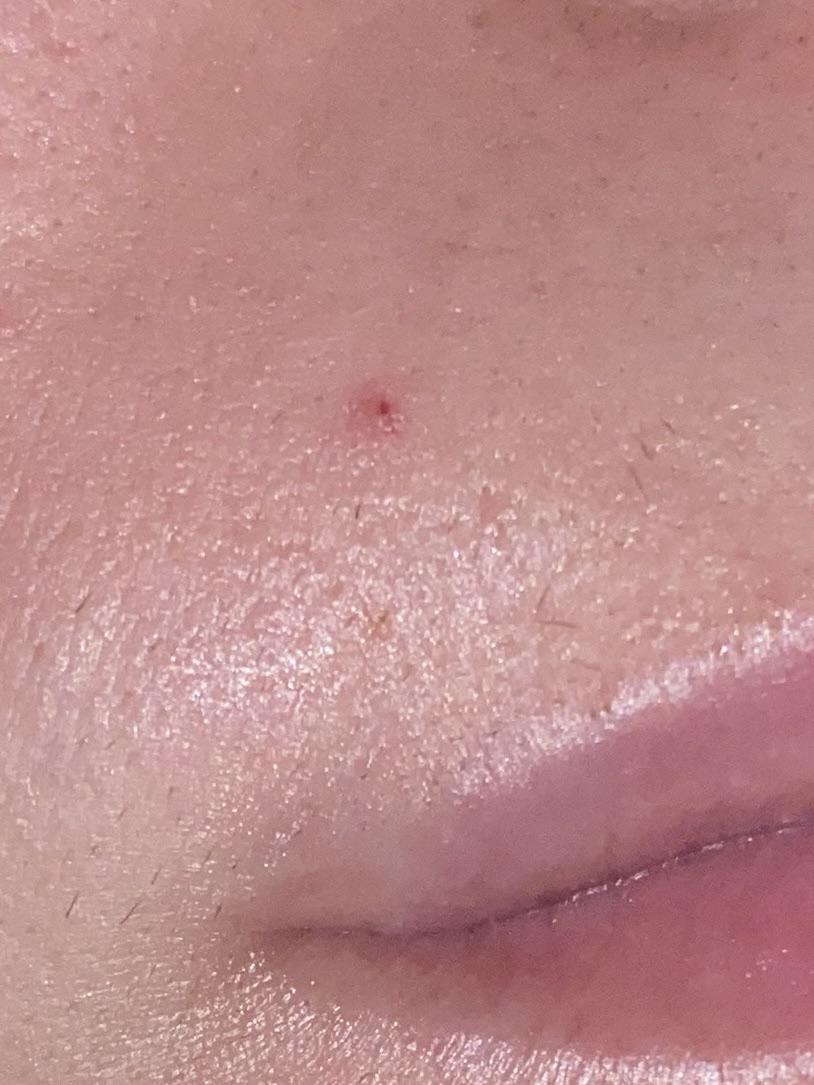 What is this? I’ve had this flat red mark on my face for a couple