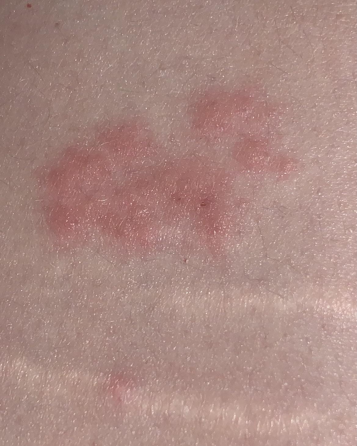 Anyone know what rash is this? It’s on my lower back, above my