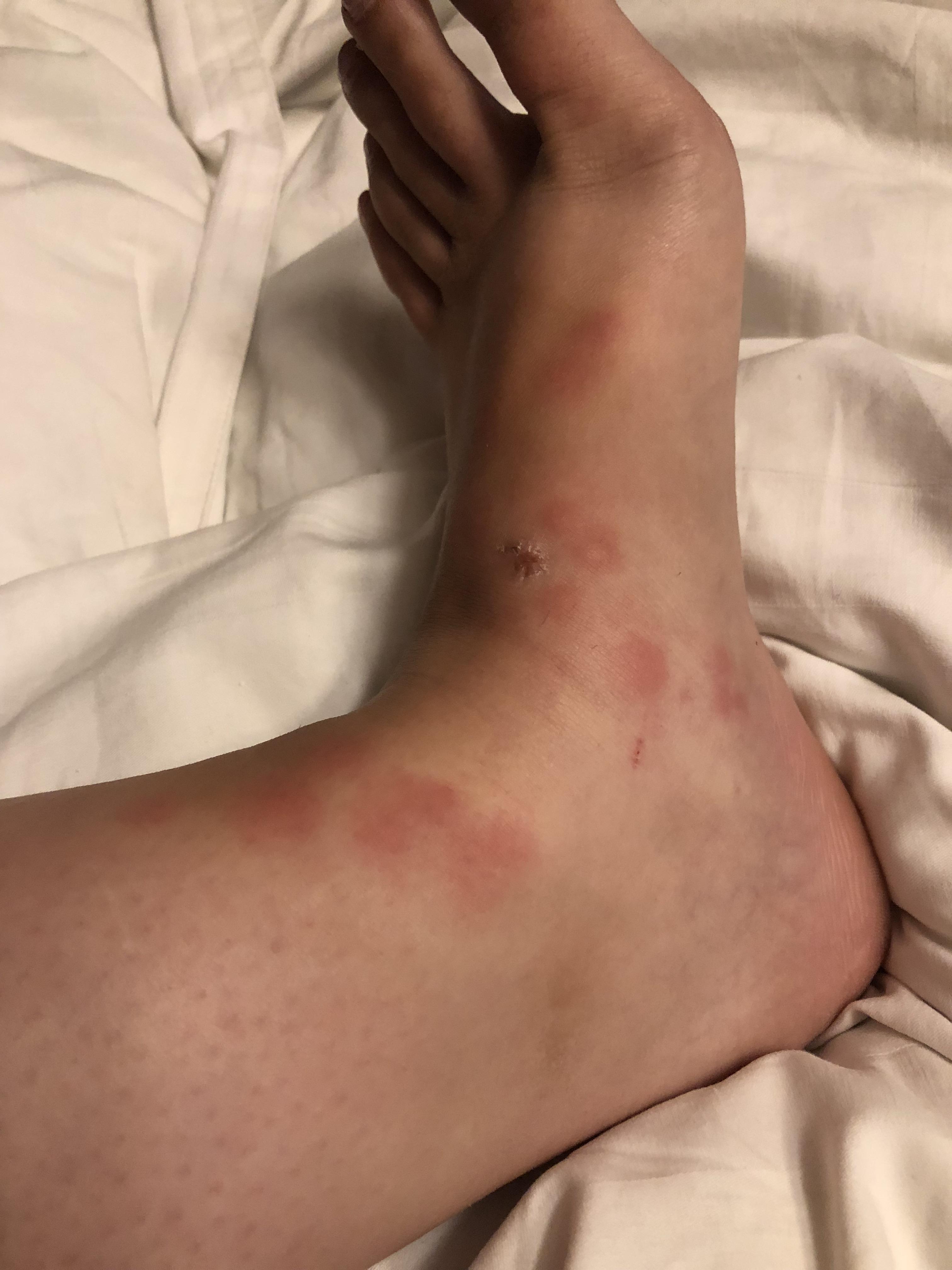 Woke up at 5am to very itchy red bumps on feet DiagnoseMe