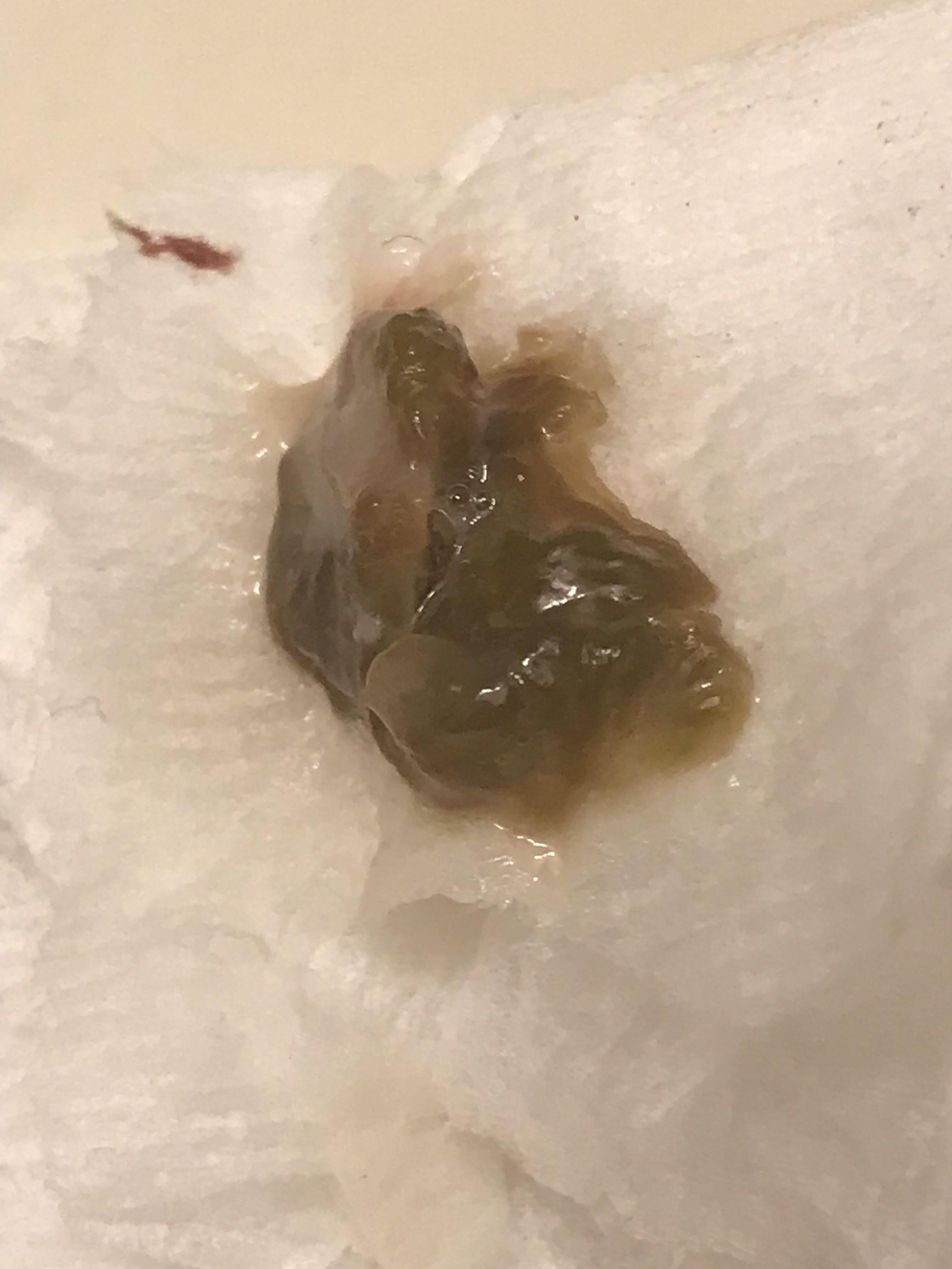 Weird mucus?? r/DiagnoseMe