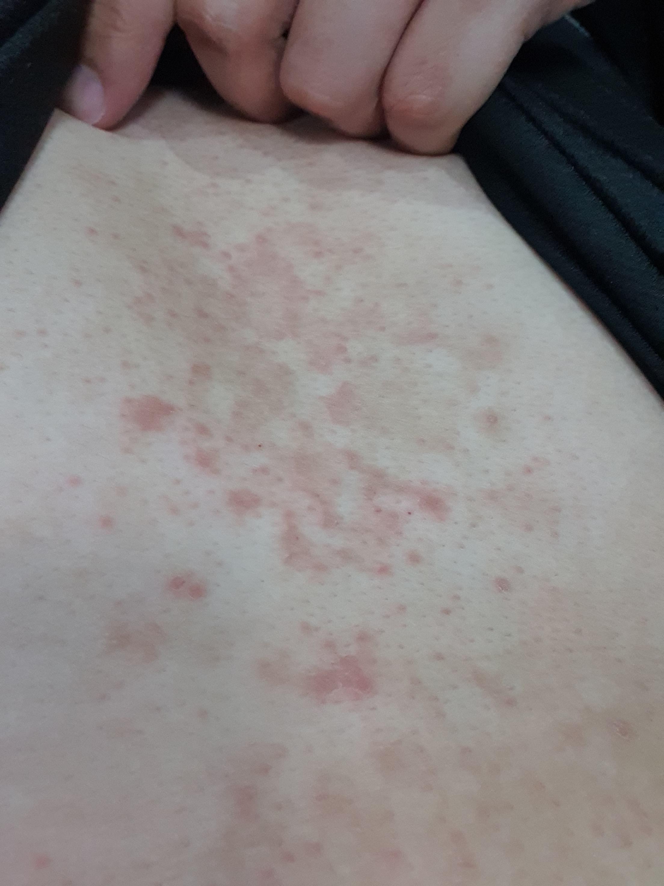 Chest part got very itchy? any remedies? and possible cause? Doesn't