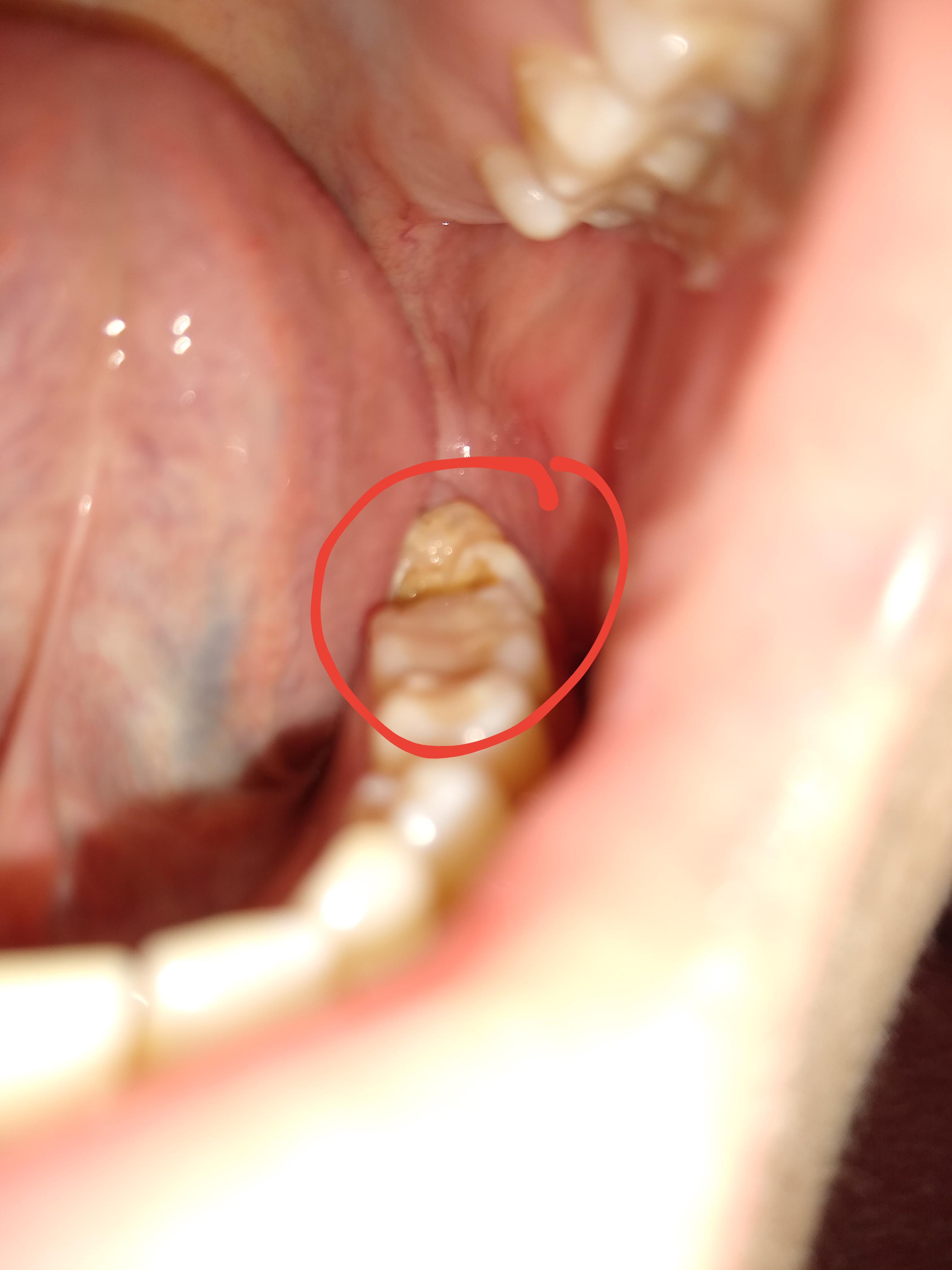 Part of tooth broke off
