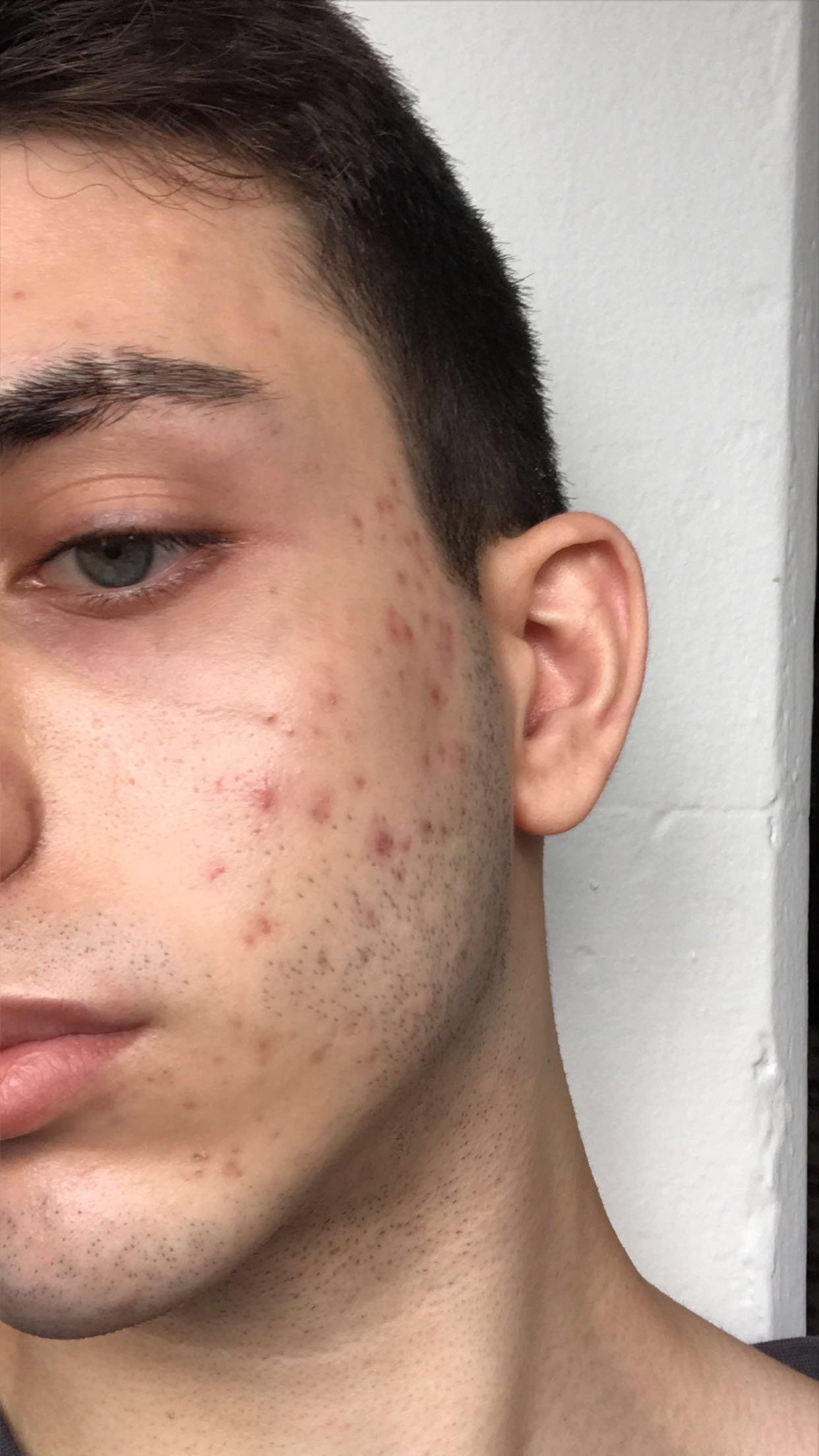 [Acne] does anyone know if this is acne or P.I.H? Not sure if i should