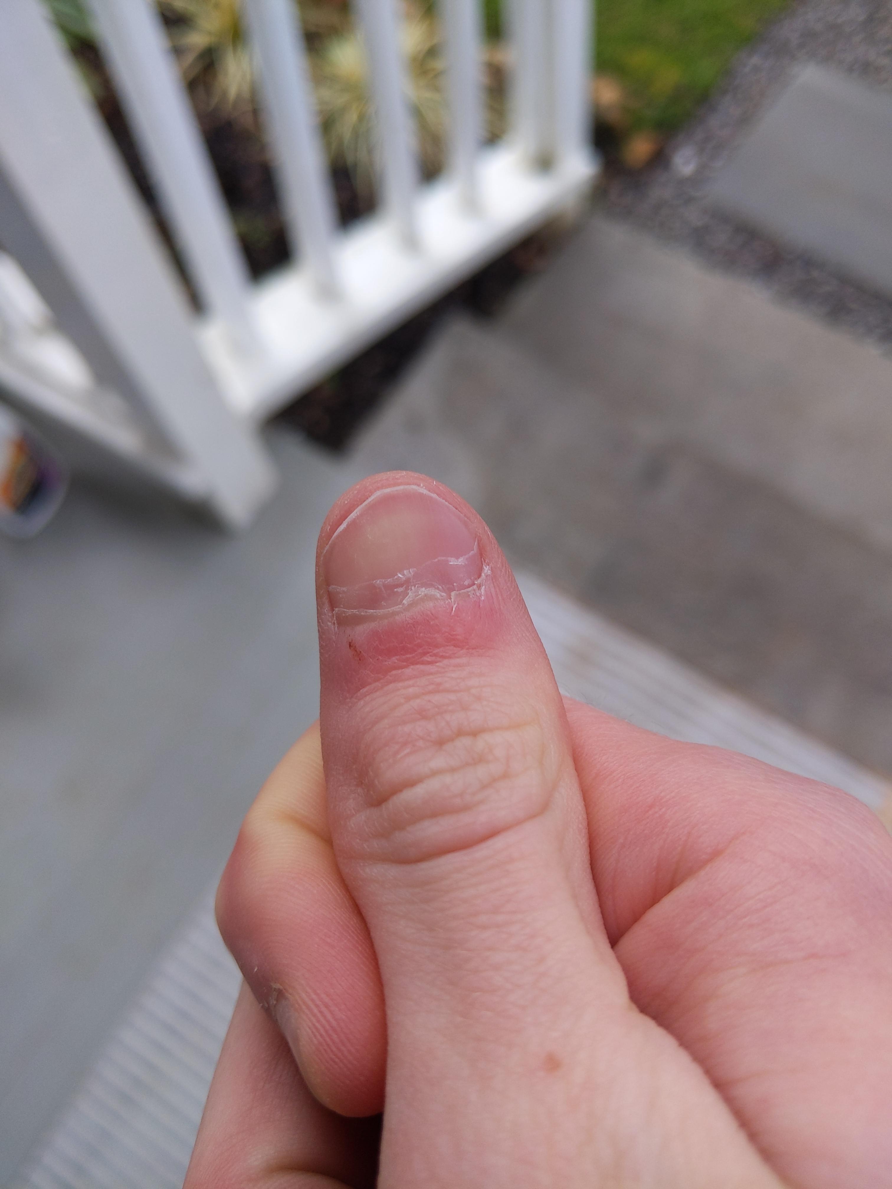 Why is my fingernail like this? r/Nails
