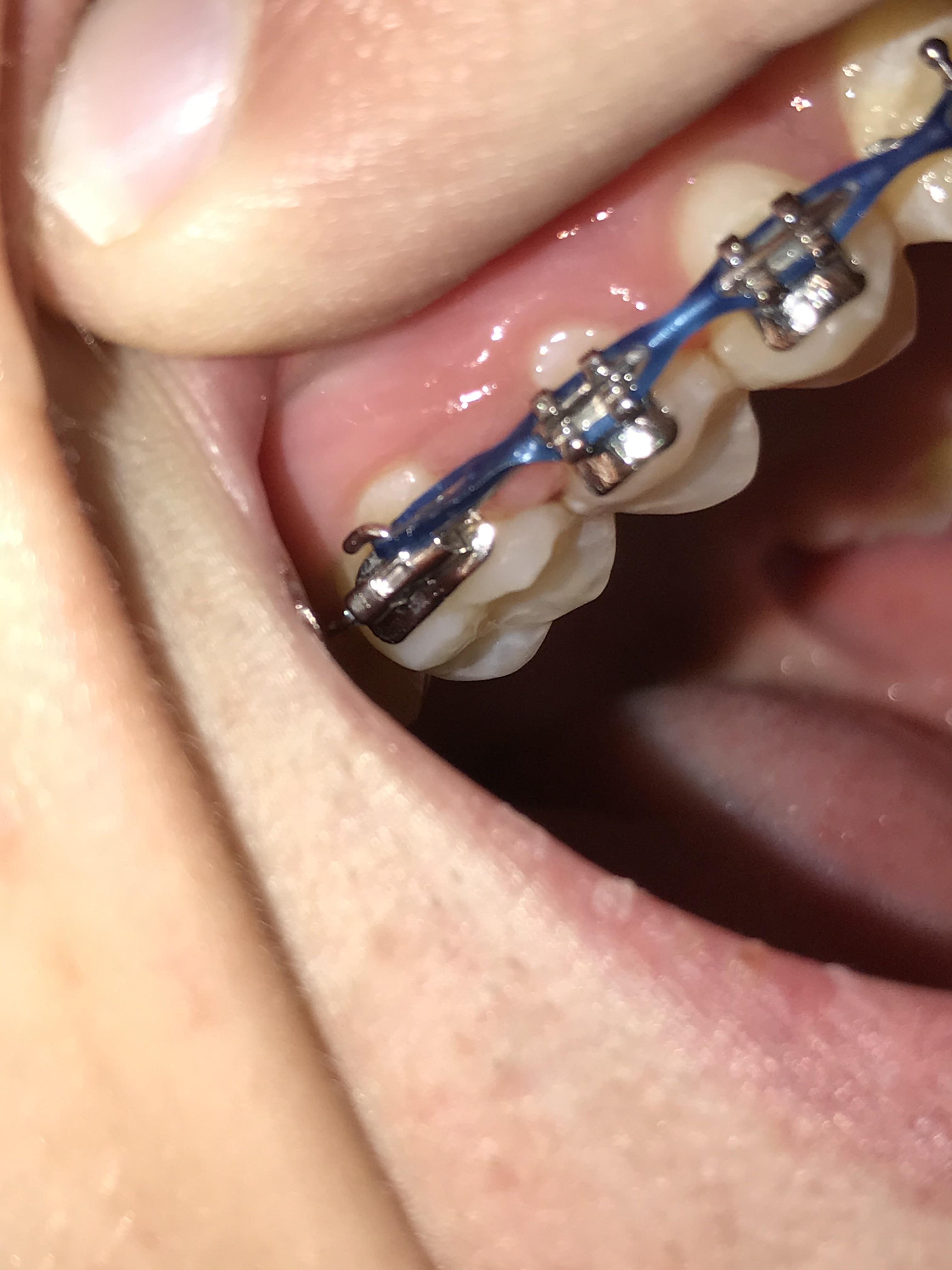 I thought there was food stuck in my braces but it turns out my gums