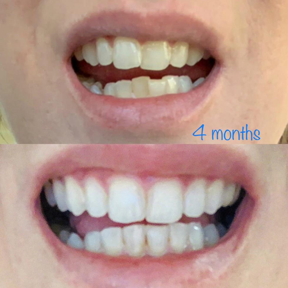 Month 4 and I’m sooo happy with my result so far! The whitening gel really works too if you use