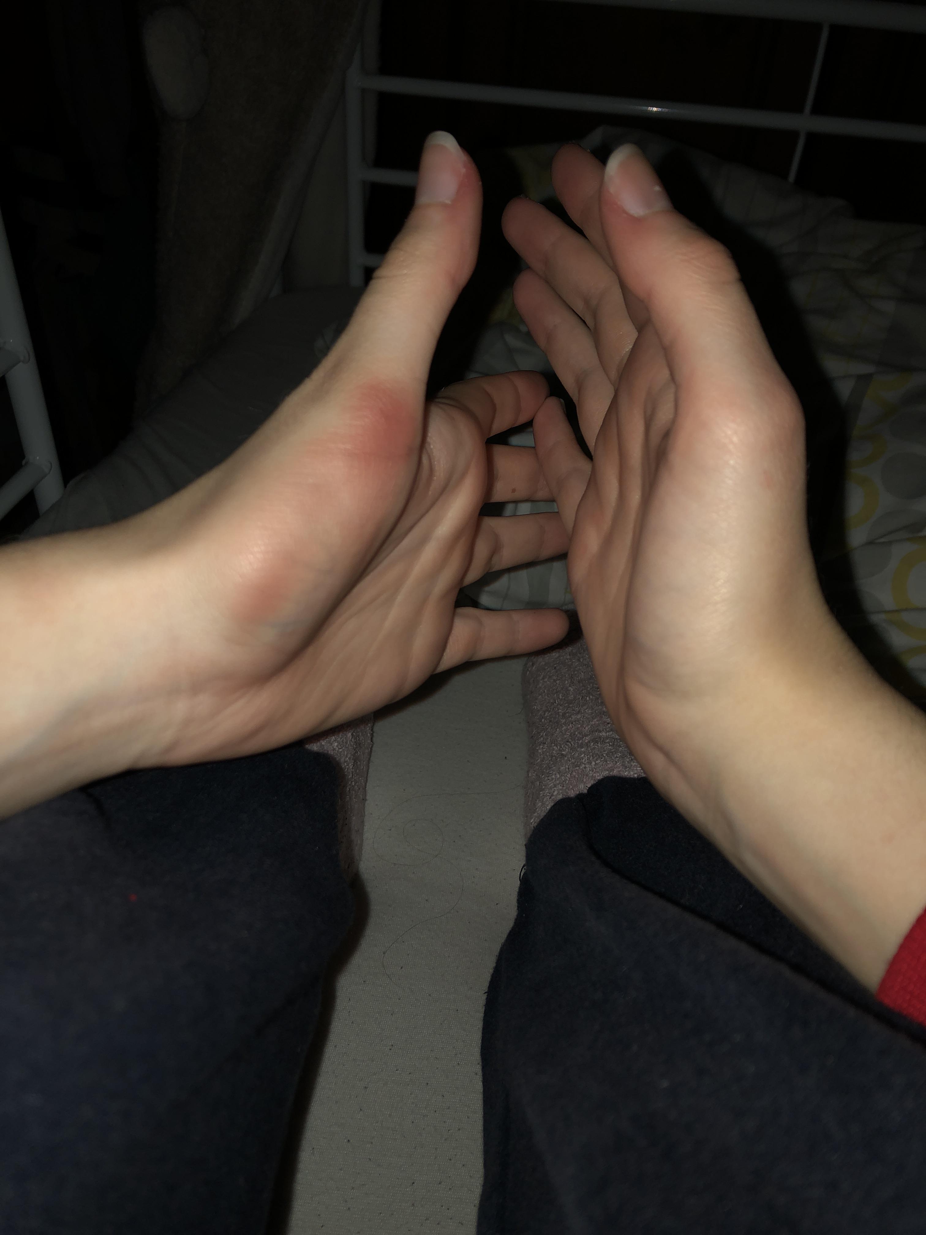 so i played volleyball today in school and i just noticed a bruise but