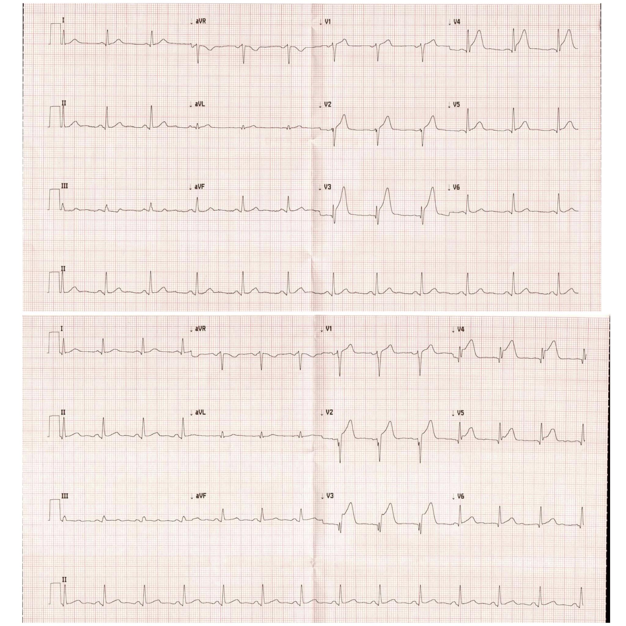 Male in 30's, brought by EMS for chest pain. Top 12 lead at time of