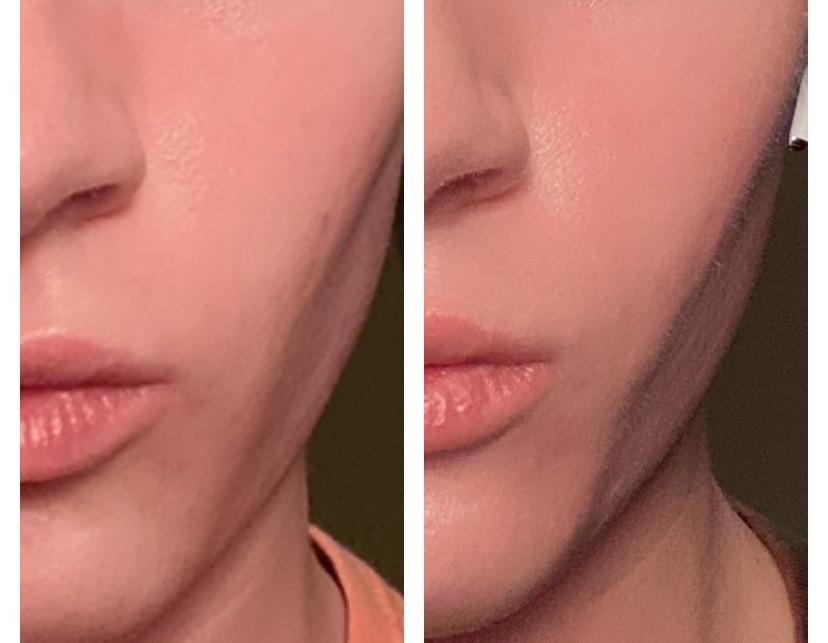 [B&A] Using Differin (Adapalene .1) to improve the look of acne scars