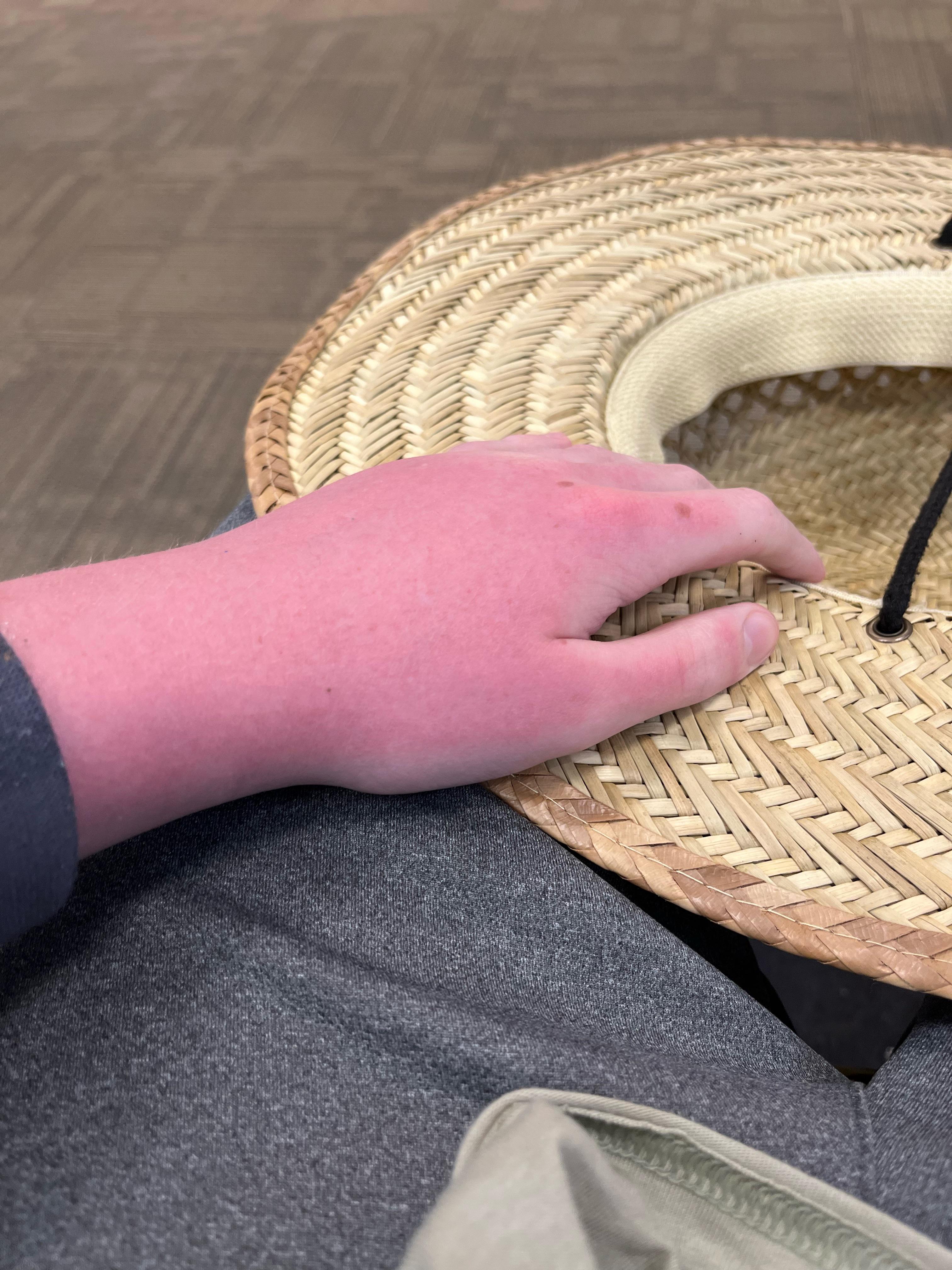 My hands are turning purple after getting sunburned r/Wellthatsucks