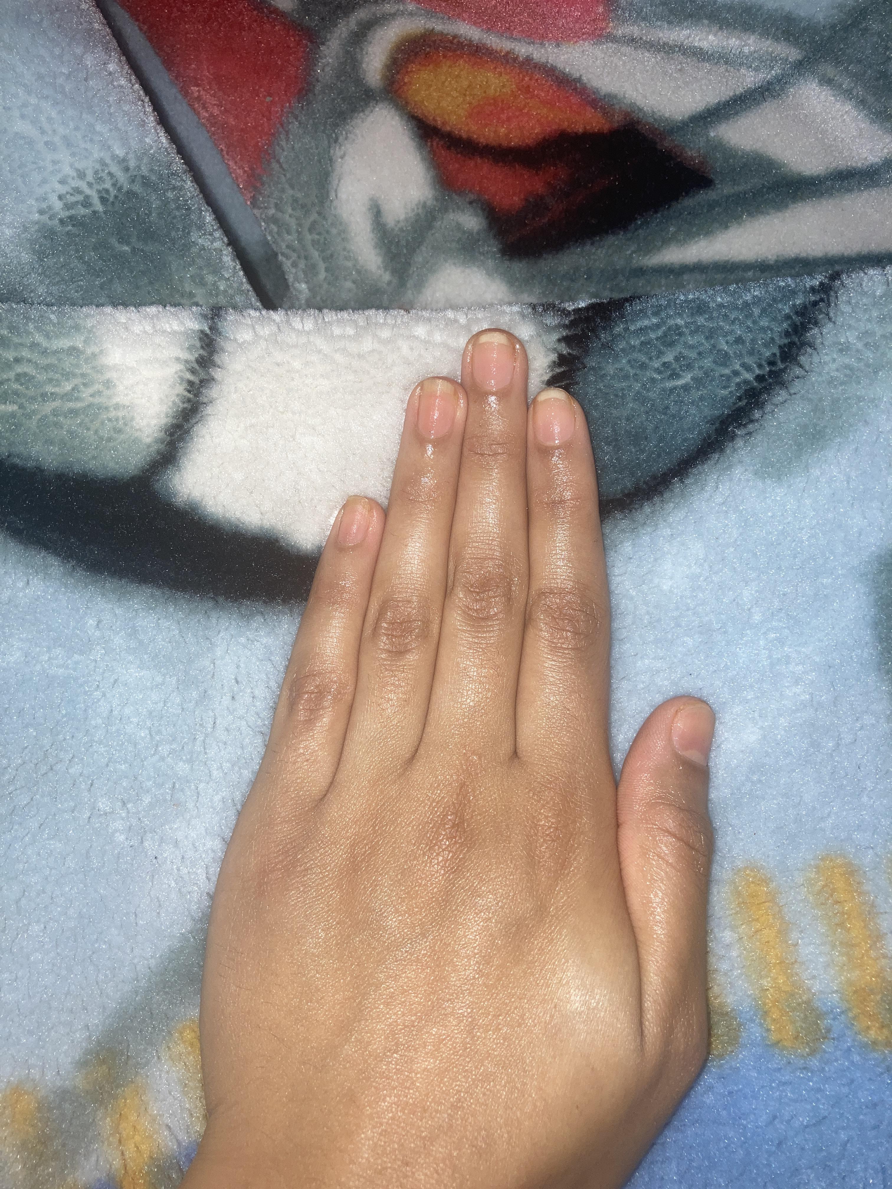 Why do my nail beds keep moving back instead of growing? r/nailbiting