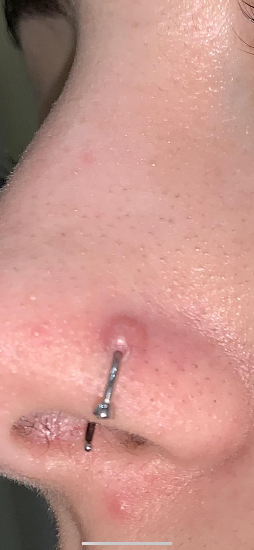 Keloid above nostril piercing. Had my first piercing done in September