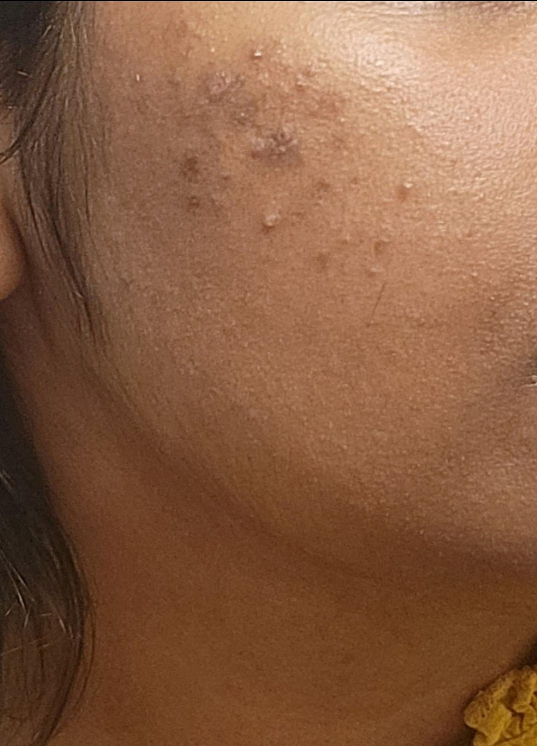 [ACNE] Seeking advice for my acne scars and textured skin. I've been