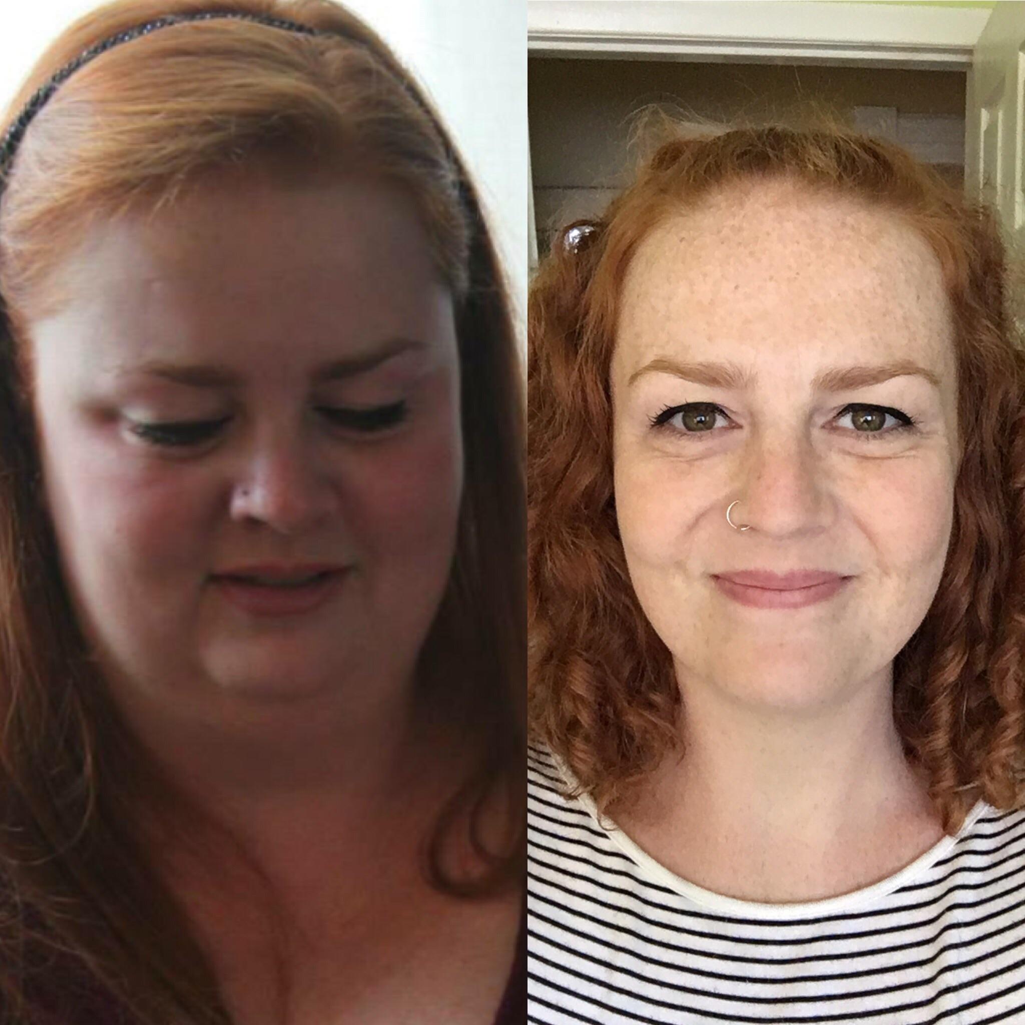 Top 105+ Pictures Cushing's Syndrome Cushing's Disease Before And After