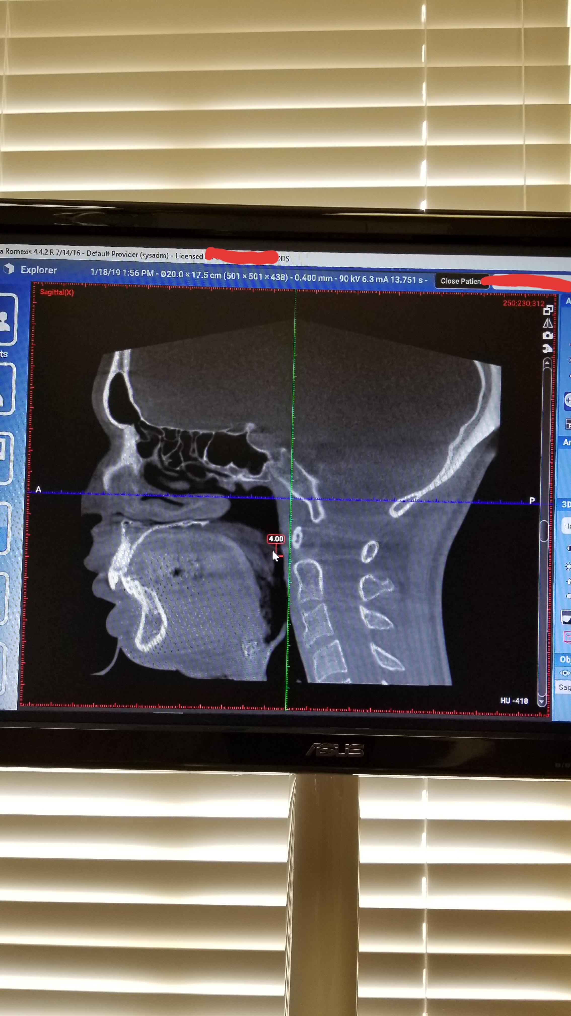 Here's a CT scan of my airway measured 4cm across due to my chronic TMJ