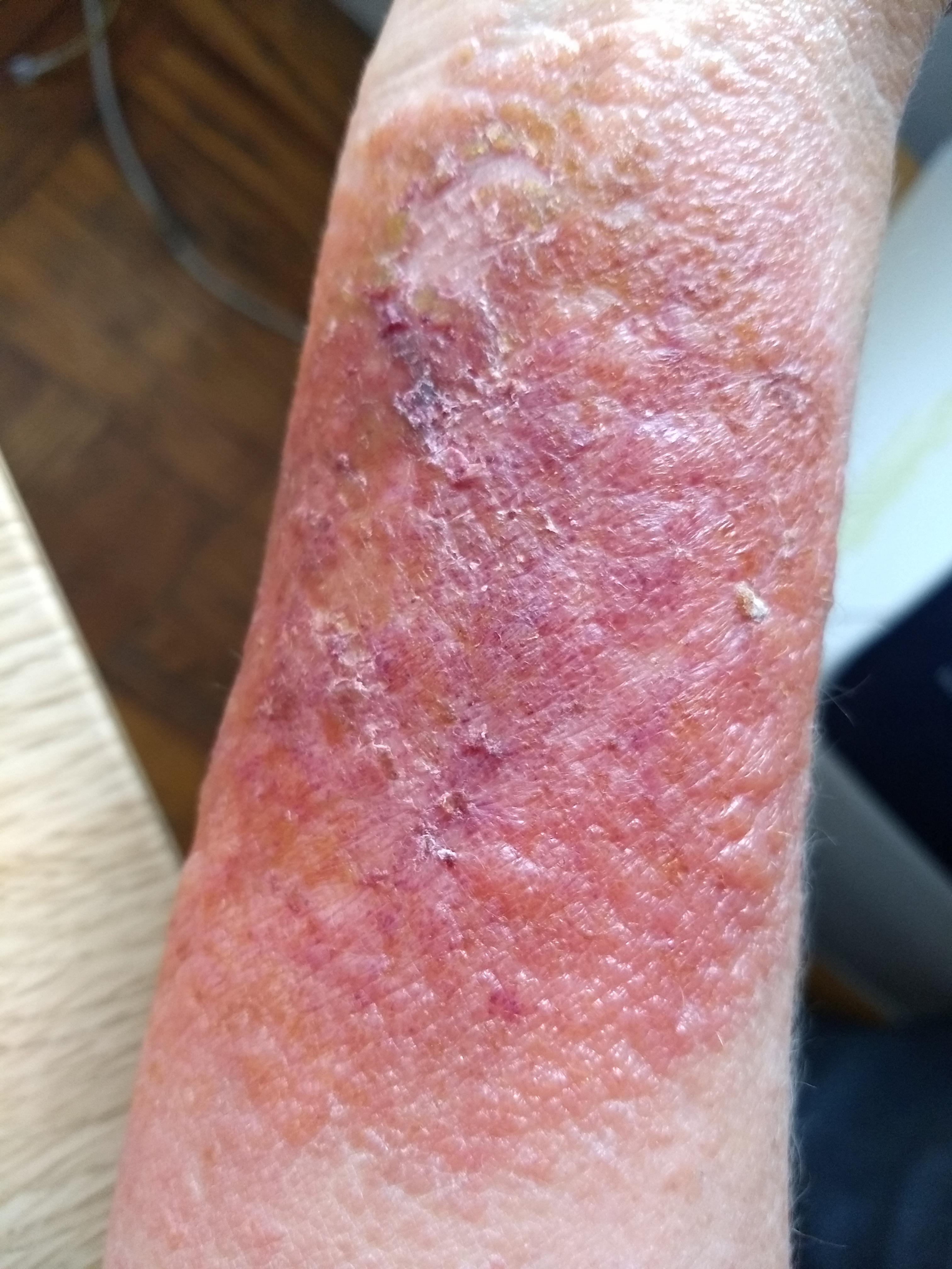 Is It Safe To Burn Ivy