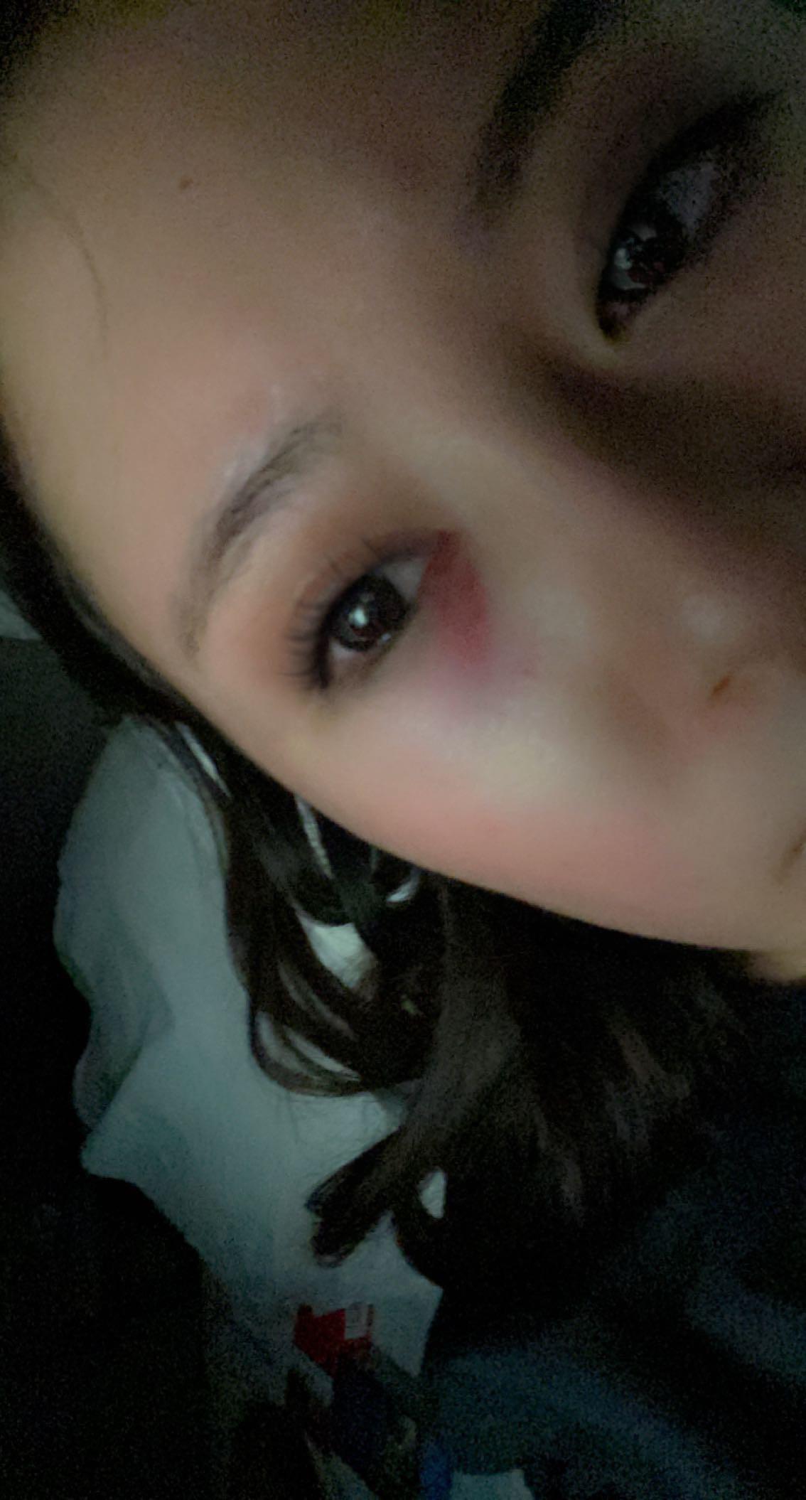 How to heal a black eye quickly? [routine help] r/SkincareAddiction