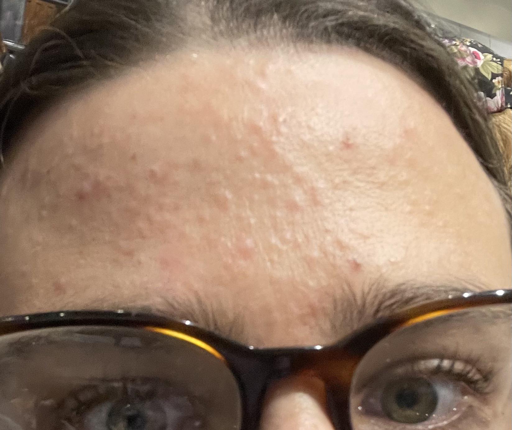 [Acne] No matter what I try (exfoliating a ton, exfoliating barely at