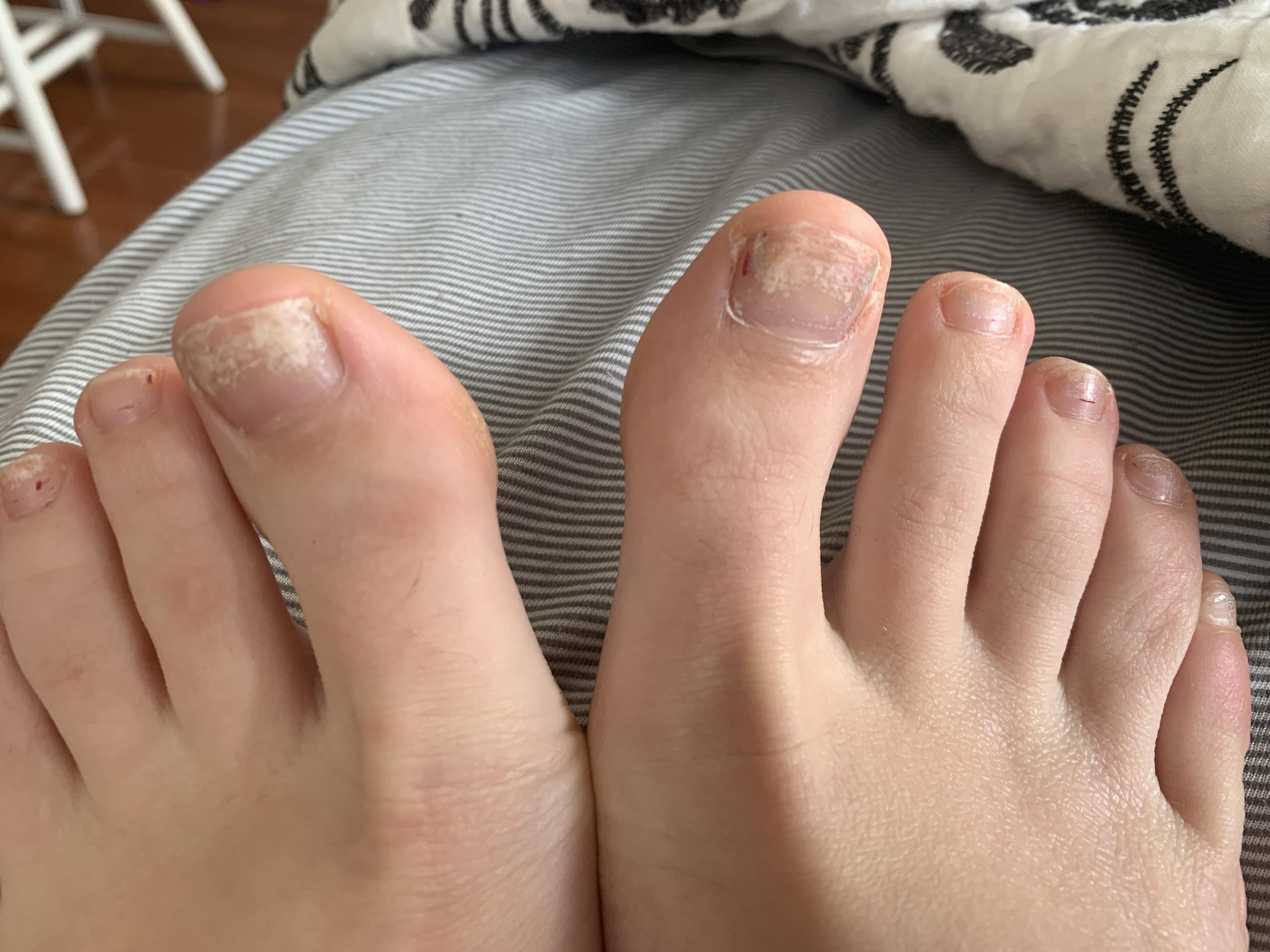 Does this look like nail fungus? It’s been a long time