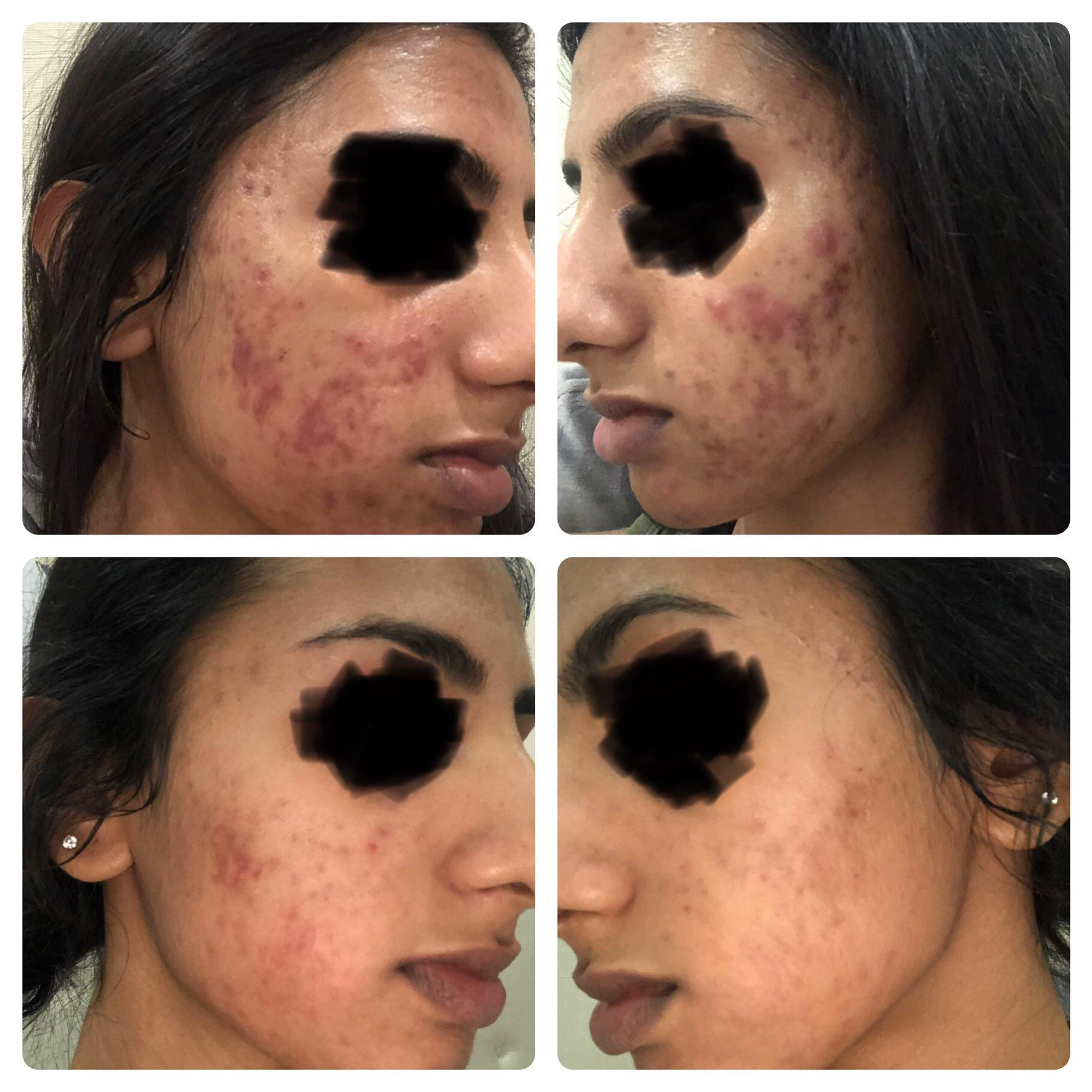 [B&A] the difference 2 months of doxycycline, clindamycin, tretinoin