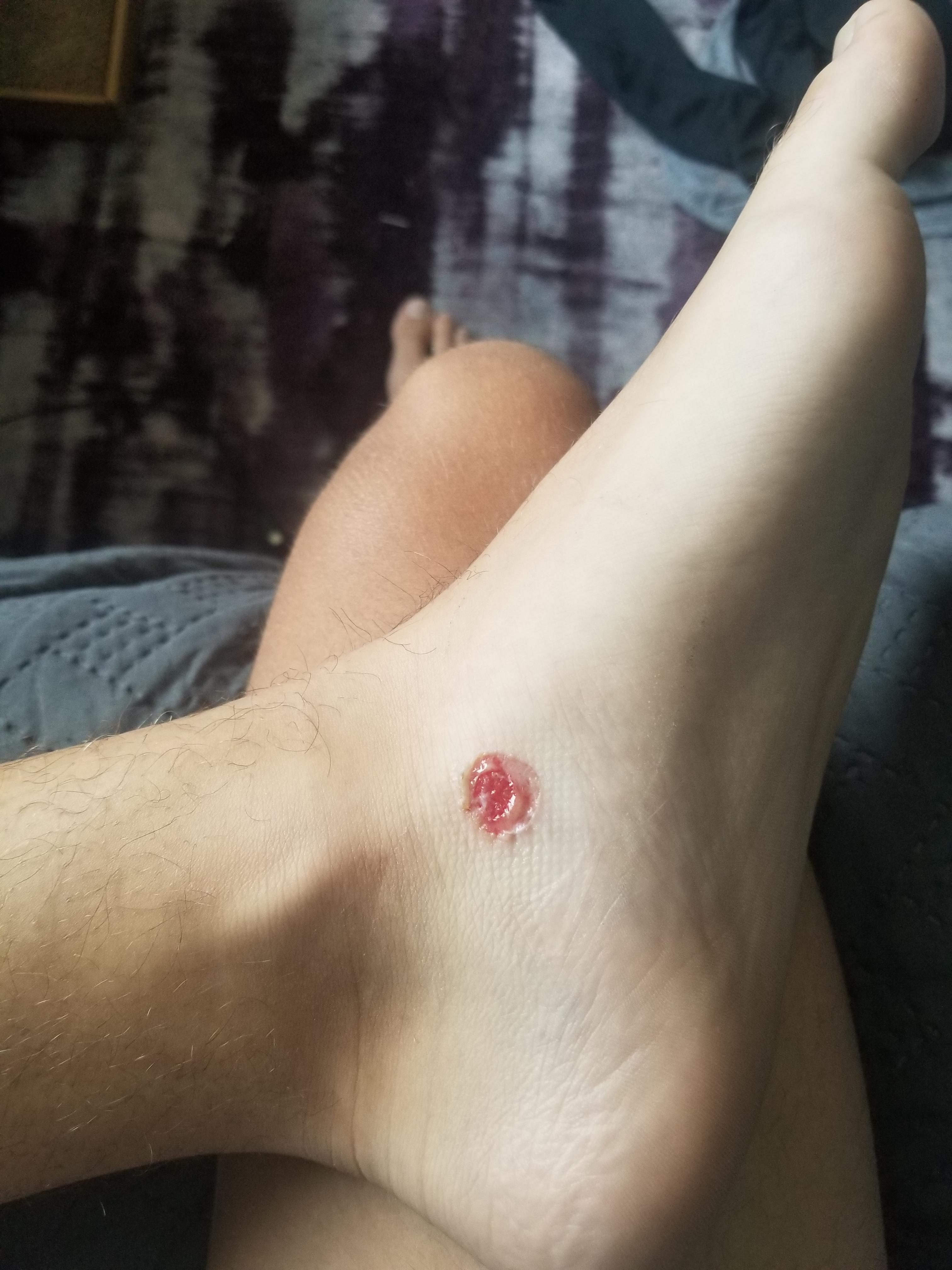 Blister my skates gave me the other day. How can I stop this from