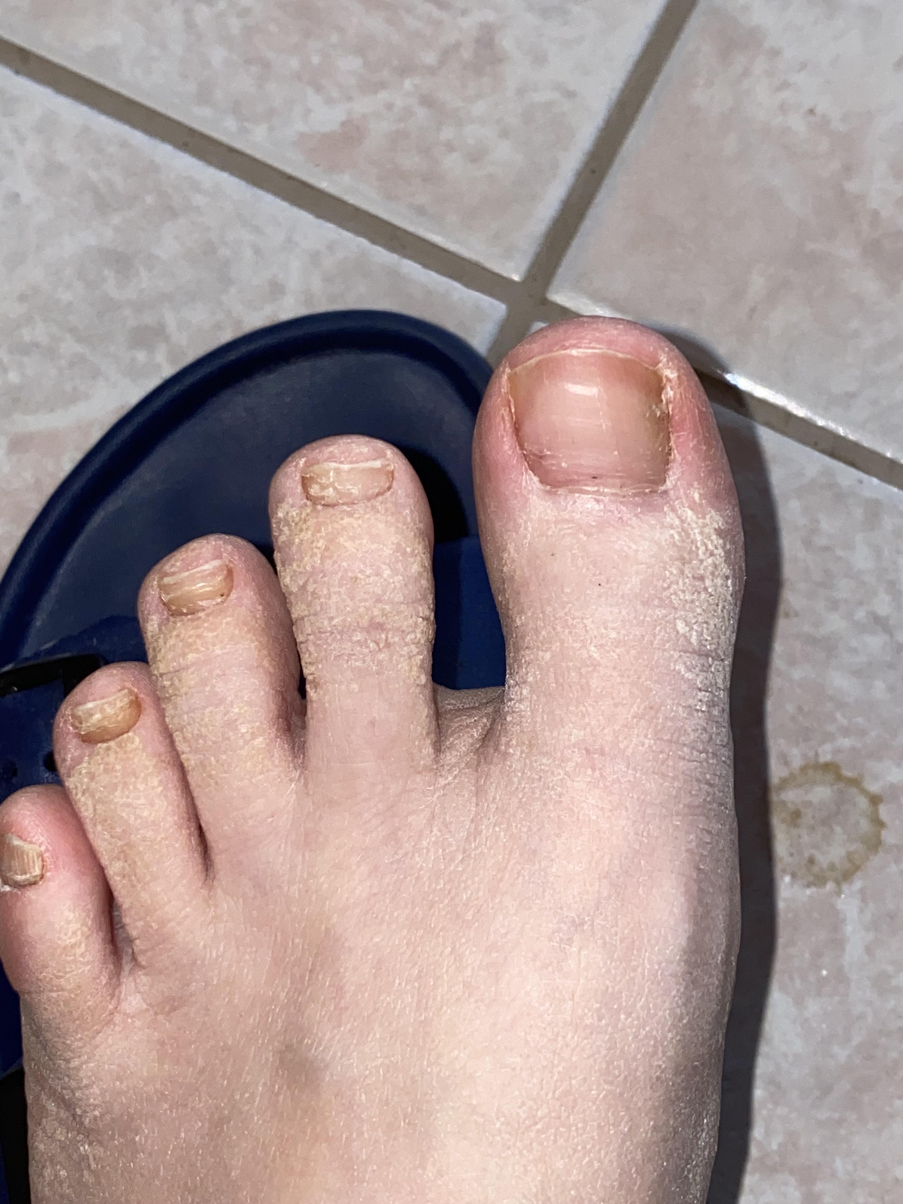 Why Do I Have White Skin On My Feet at Daniel Gallo blog