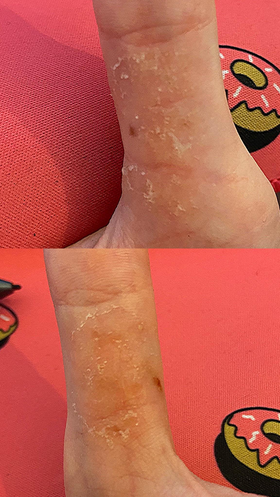 Seeking advice non prescription creme to soothe dyshidrodis? (Not heal