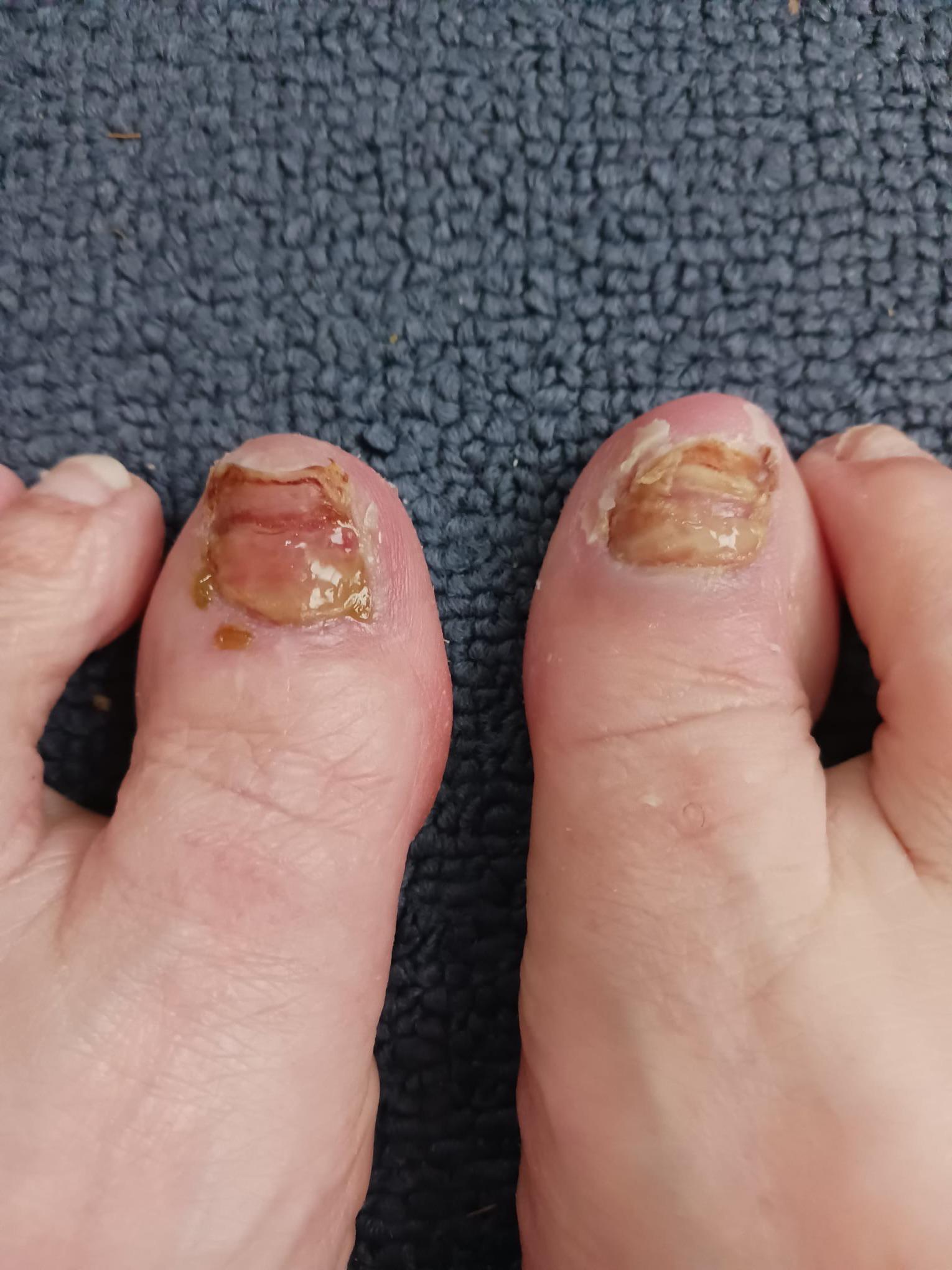 Permanent removal r/Ingrown_Toenails