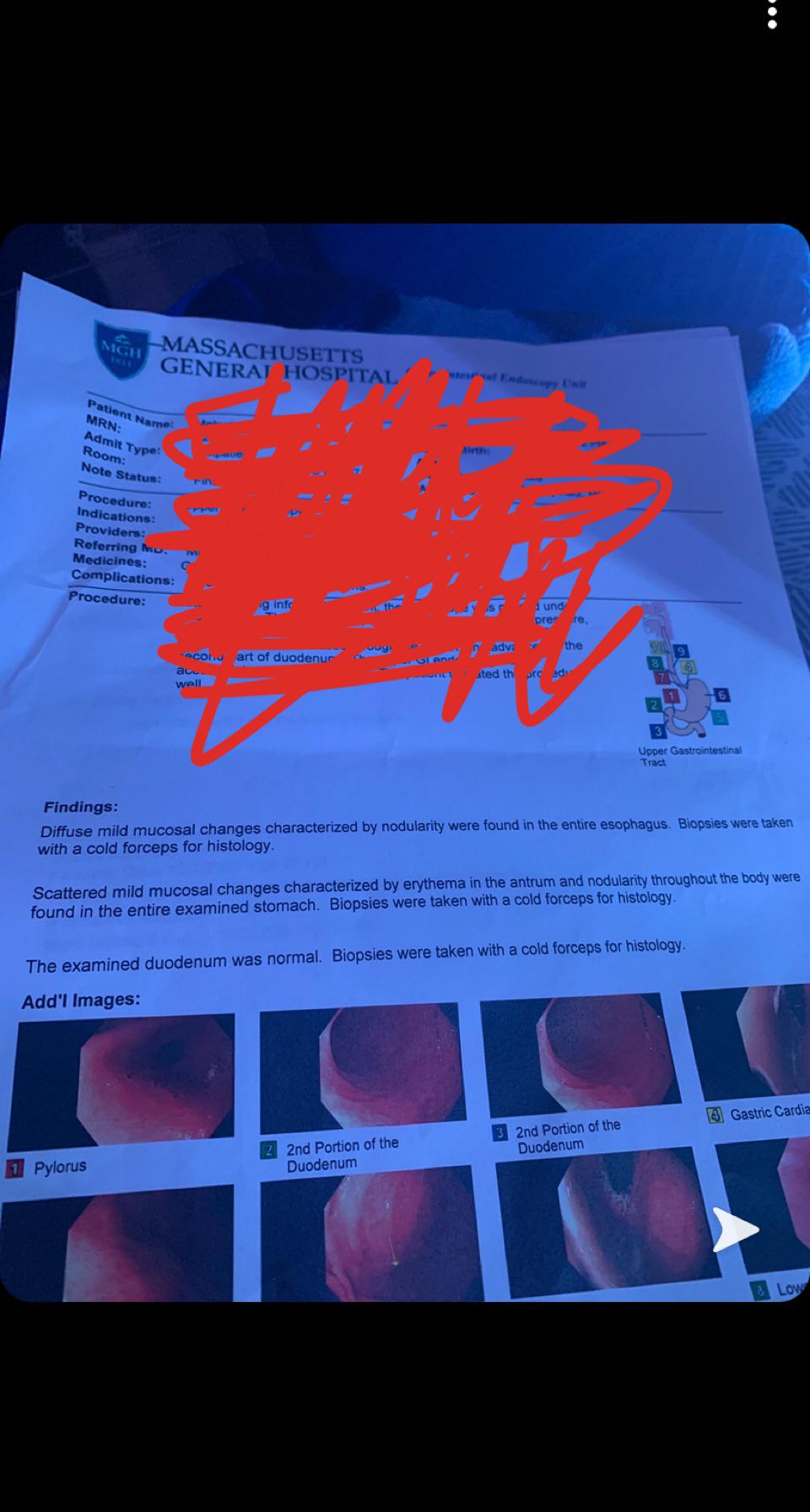 Endoscopy results came back about a month ago, and my GI told me the