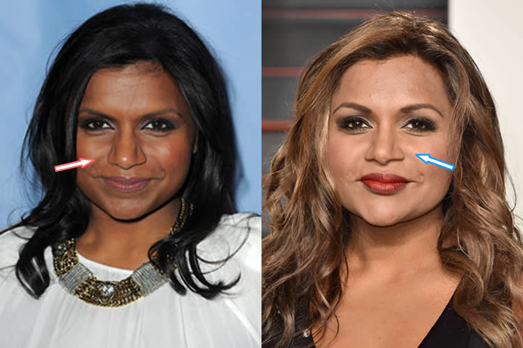 Mindy Kaling Plastic Surgery And Biography : U/Healthcaredose89