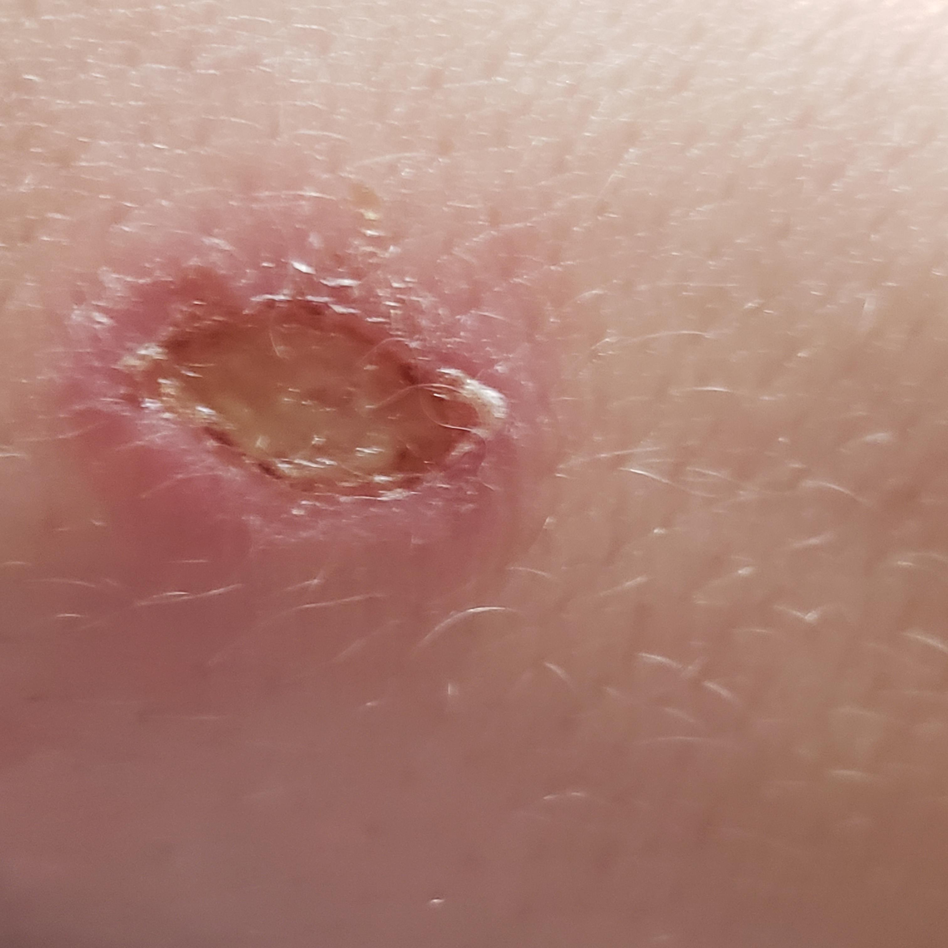 Hot glue gun burn what do I do? Is it infected? r/medical