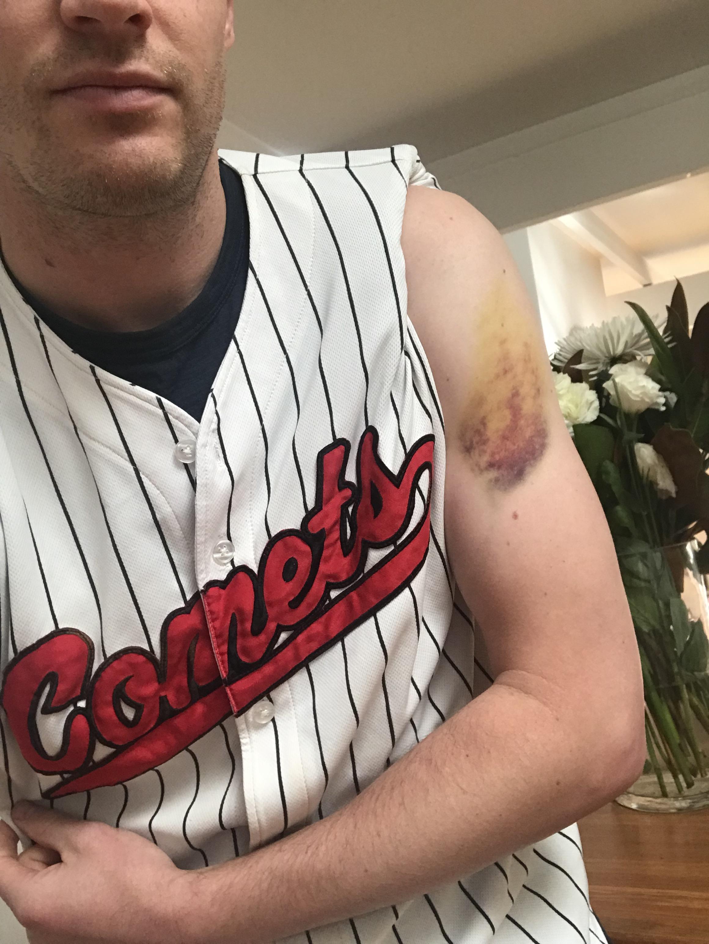 My baseball bruise could be our team logo