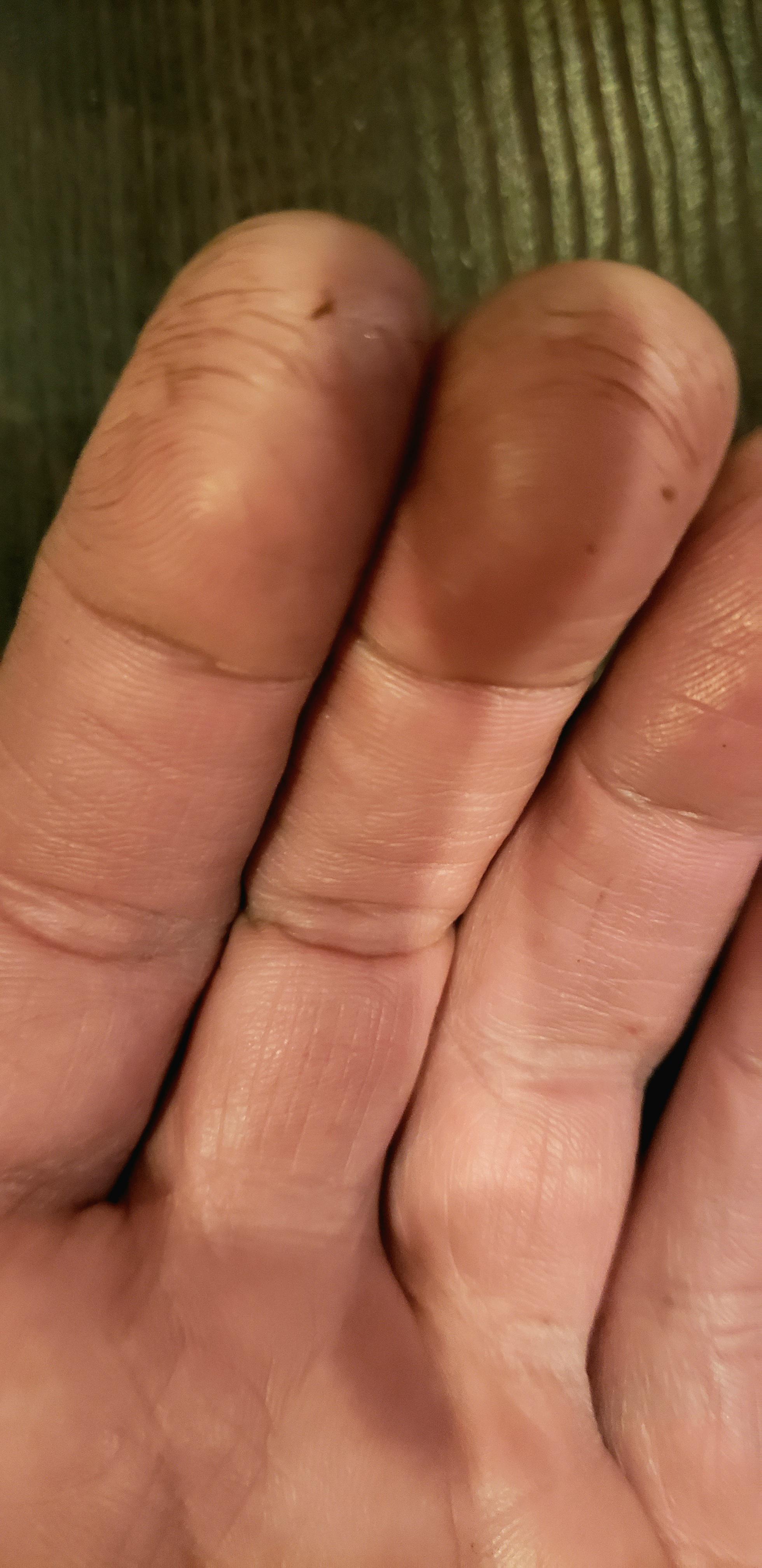 Anybody know what could be causing these cracks on my fingertips? I got
