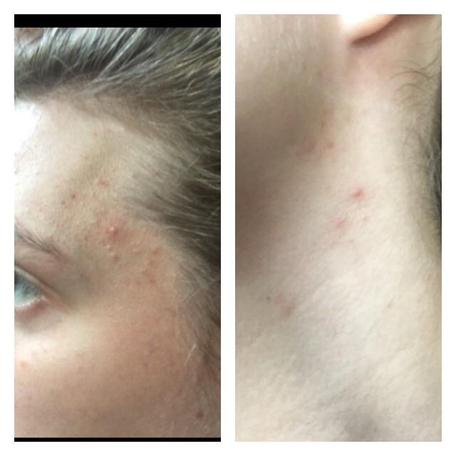 [Acne] Has anyone dealt with acne on neck just under jawline? Acne on