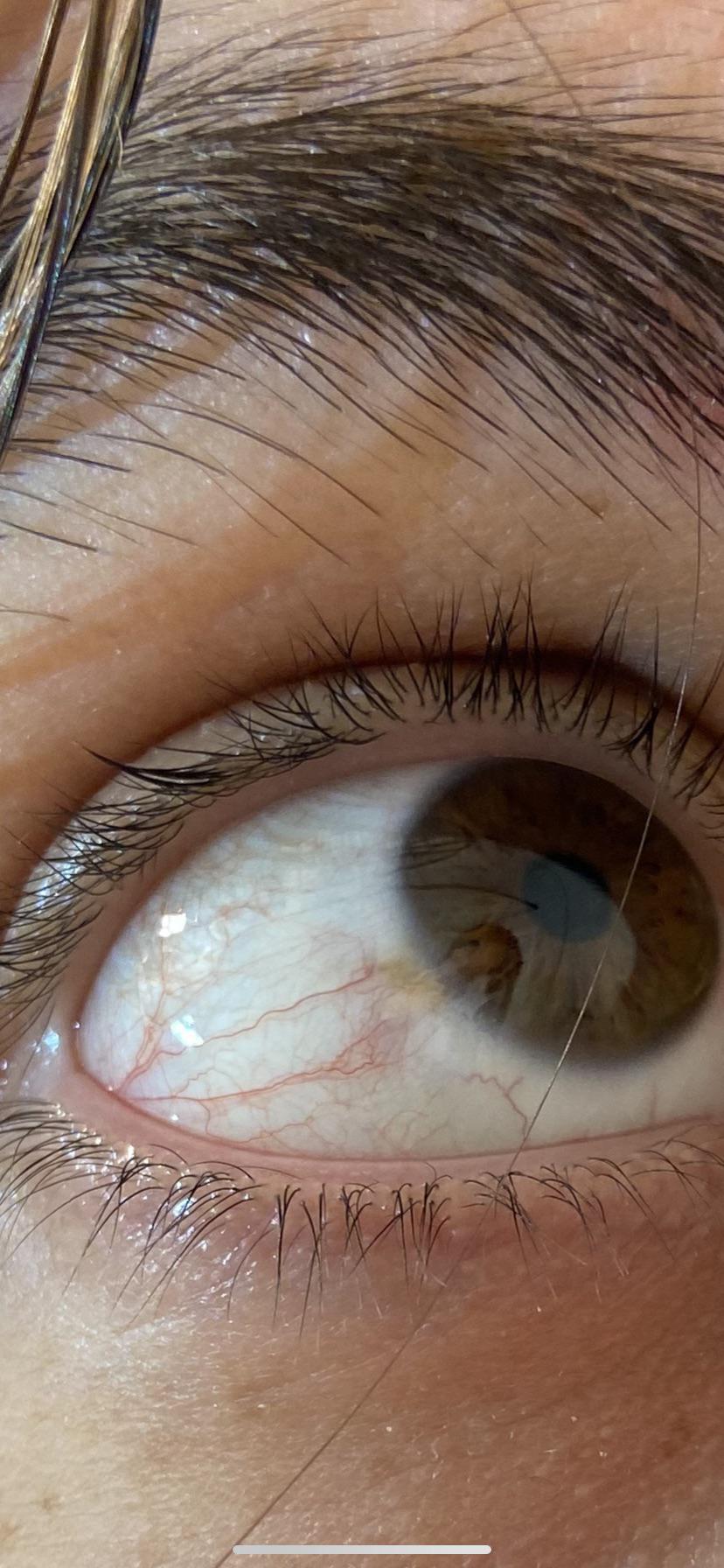 Pigmented spot in eye with presumed feeder vein? Is this abnormal? r