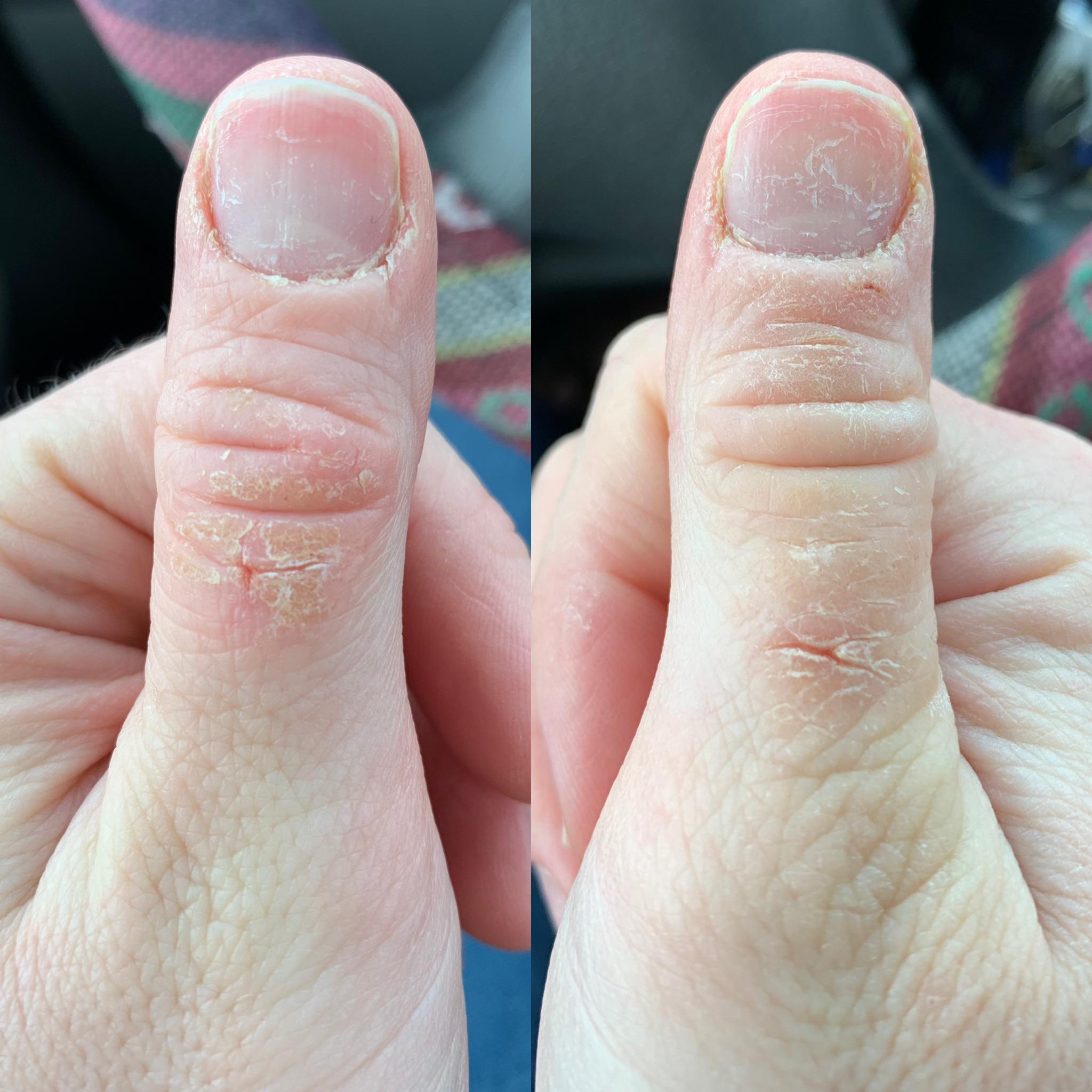 Itchy scaly spots on both thumbs and sometimes other hand and toe